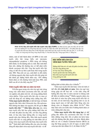 413
nhieân, moät soá nhoû beänh nhaân vôùi BPH coù taân sinh
tuyeán tieàn lieät trong bieåu moâ (prostatic
intraepithelial neoplasia = PIN) (taêng saûn khoâng
ñieån hình), laø toån thöông tieàn aùc tính. Khi sinh thieát
theo doõi, nhöõng toån thöông naøy coù theå phaùt trieån
thaønh carcinom tieàn lieät. Ung thö tuyeán tieàn lieät
cuõng coù theå toàn taïi beân caïnh hoaëc beân trong tuyeán
nhö PIN. Theo doõi saùt sao, sinh thieát vaø ñoái chieáu
vôùi khaùng nguyeân ñaëc hieäu tuyeán tieàn lieät giuùp ích
khi ñaùnh giaù nhöõng beänh nhaân naøy. 10% nhöõng
beänh nhaân coù toån thöông laønh tính hoaëc PIN, sinh
thieát sau ñoù seõ cho thaáy ung thö.51,54-56
Vieâm tuyeán tieàn lieät vaø vieâm tuùi tinh
Vôùi taàm quan troïng cuûa sieâu aâm ngaû tröïc traøng
trong vieäc chaån ñoaùn carcinoma tieàn lieät, chæ moät
vaøi nghieân cöùu phaân tích lôïi ích trong nhöõng beänh
vieâm nhieãm. Vieâm tuyeán tieàn lieät caáp vaø maïn coù
xuaát ñoä ñaùng keå vôùi nhöõng trieäu chöùng thay ñoåi.
Vieâm maïn tuyeán tieàn lieät coù theå keát hôïp vôùi beänh
nguyeân ñaëc hieäu nhö Chlamydia hay Mycoplasma.
Neáu khoâng tìm ñöôïc caên nguyeân, khi ñoù goïi laø ñau
tuyeán tieàn lieät.57,58
Daáu hieäu sieâu aâm cuûa vieâm
maïn tuyeán tieàn lieät bao goàm nhöõng khoái khu truù
vôùi möùc ñoä phaûn aâm thay ñoåi, voâi hoùa oáng phoùng
tinh, voû bao daøy hoaëc khoâng ñeàu vaø vuøng tuyeán
quanh nieäu ñaïo khoâng ñeàu. Daõn tónh maïch quanh
tuyeán tieàn lieät vaø caêng phoàng tuùi tinh ñöôïc moâ taû
trong vieâm maïn tuyeán tieàn lieät hoaëc ñau tuyeán tieàn
lieät.58
Sinh thieát döôùi höôùng daãn cuûa sieâu aâm ñöôïc
duøng ñeå nhaän ñònh vieâm maïn tuyeán tieàn lieät vaø ñeå
Hình 10-18. Sau caét tuyeán tieàn lieät xuyeân nieäu ñaïo (TURP). A, Hình caét doïc giöõa cho thaáy noát moâ nhoû
(muõi teân) thöôøng loài vaøo trong loøng nieäu ñaïo sau khi caét. Nieäu ñaïo tröôùc daõn tôùi loài tinh, v, cho pheùp nieäu ñaïo sau
vaø tuyeán tieàn lieät hoaït ñoäng nhö cô thaét. B, Queùt vaønh cheách qua ñaùy tuyeán cho thaáy nieäu ñaïo daõn, U, vaø loài tinh,
v. Thaáy vaøi vuøng taêng saûn trong vuøng chuyeån tieáp, T, ôû hai beân nieäu ñaïo. Vuøng ngoaïi bieân, P, ñaúng aâm.
ÑAËC ÑIEÅM SIEÂU AÂM CUÛA
VIEÂM MAÏN TUYEÁN TIEÀN LIEÄT
Nhöõng khoái khu truù vôùi möùc ñoä phaûn aâm khaùc nhau
Voâi hoùa oáng phoùng tinh
Voû bao daøy hoaëc khoâng ñeàu
Tuyeán quanh nieäu ñaïo khoâng ñeàu
Daõn tónh maïch quanh tuyeán tieàn lieät
Caêng phoàng tuùi tinh
Tuyeán tieàn lieät
khaúng ñònh söï hieän dieän cuûa vi khuaån.59
Vieâm maïn tuyeán tieàn lieät hoaëc vieâm tuùi tinh coù
theå daãn ñeán tinh dòch coù maùu. Sieâu aâm ngaû tröïc
traøng giuùp ích ñeå loaïi tröø u taân sinh, cuõng ñeå
höôùng daãn choïc huùt vaø tieâm steroid vaø khaùng sinh
ñeå ñieàu trò nhieãm truøng.60
Nhieàu nguyeân nhaân cuûa
tinh dòch coù maùu bao goàm nang tuyeán tieàn lieät vaø
tuùi tinh, soûi tuùi tinh hoaëc oáng phoùng tinh vaø caùc dò
daïng maïch maùu coù theå phaùt hieän baèng sieâu aâm
thang xaùm vaø Doppler maøu (Hình 10-19).61
Neân
thöïc hieän sieâu aâm tröôùc tieân ôû nhöõng beänh nhaân coù
trieäu chöùng khoù chòu naøy.
Vieâm maïn tuyeán tieàn lieät daïng haït coù theå
gioáng ñaëc ñieåm cuûa carcinoma tieàn lieät. Coù theå
thaáy nhöõng vuøng nhoû, lôùn coù phaûn aâm keùm hoaëc
moät toån thöông ñôn ñoäc phaûn aâm keùm. Beänh nhaân
ñieàu trò vôùi vi khuaån Calmette-Gueùrin (BCG) trò
ung thö baøng quang laø yeáu toá nguy cô phaùt trieån
vieâm haït tieàn lieät (Hình 10-13, B; Hình 10-20).62
Simpo PDF Merge and Split Unregistered Version - http://www.simpopdf.com
 