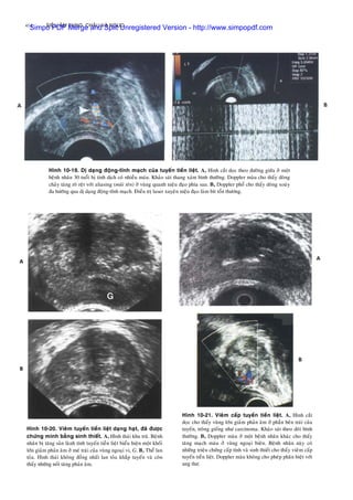 SIEÂU AÂM BUÏNG, CHAÄU VAØ NGÖÏC414
Hình 10-19. Dò daïng ñoäng-tónh maïch cuûa tuyeán tieàn lieät. A, Hình caét doïc theo ñöôøng giöõa ôû moät
beänh nhaân 30 tuoåi bò tinh dòch coù nhieàu maùu. Khaûo saùt thang xaùm bình thöôøng. Doppler maøu cho thaáy doøng
chaûy taêng roõ reät vôùi aliasing (muõi teân) ôû vuøng quanh nieäu ñaïo phía sau. B, Doppler phoå cho thaáy doøng xoaùy
ña höôùng qua dò daïng ñoäng-tónh maïch. Ñieàu trò laser xuyeân nieäu ñaïo laøm bít toån thöông.
Hình 10-21. Vieâm caáp tuyeán tieàn lieät. A, Hình caét
doïc cho thaáy vuøng lôùn giaûm phaûn aâm ôû phaàn beân traùi cuûa
tuyeán, troâng gioáng nhö carcinoma. Khaûo saùt theo doõi bình
thöôøng. B, Doppler maøu ôû moät beänh nhaân khaùc cho thaáy
taêng maïch maùu ôû vuøng ngoaïi bieân. Beänh nhaân naøy coù
nhöõng trieäu chöùng caáp tính vaø sinh thieát cho thaáy vieâm caáp
tuyeán tieàn lieät. Doppler maøu khoâng cho pheùp phaân bieät vôùi
ung thö.
Hình 10-20. Vieâm tuyeán tieàn lieät daïng haït, ñaõ ñöôïc
chöùng minh baèng sinh thieát. A, Hình thaùi khu truù. Beänh
nhaân bò taêng saûn laønh tính tuyeán tieàn lieät bieåu hieän moät khoái
lôùn giaûm phaûn aâm ôû meù traùi cuûa vuøng ngoaïi vi, G. B, Theå lan
toûa. Hình thaùi khoâng ñoàng nhaát lan toûa khaép tuyeán vaø coøn
thaáy nhöõng noát taêng phaûn aâm.
Simpo PDF Merge and Split Unregistered Version - http://www.simpopdf.com
 