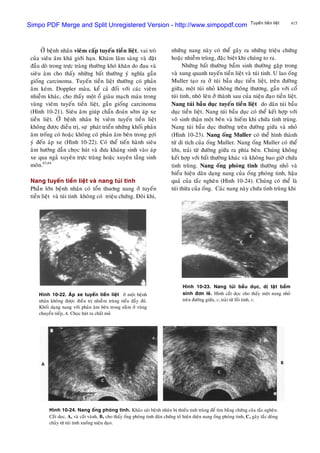 415Tuyeán tieàn lieät
ÔÛ beänh nhaân vieâm caáp tuyeán tieàn lieät, vai troø
cuûa sieâu aâm khaù giôùi haïn. Khaùm laâm saøng vaø ñaët
ñaàu doø trong tröïc traøng thöôøng khoù khaên do ñau vaø
sieâu aâm cho thaáy nhöõng baát thöôøng yù nghóa gaàn
gioáng carcinoma. Tuyeán tieàn lieät thöôøng coù phaûn
aâm keùm. Doppler maøu, keå caû ñoái vôùi caùc vieâm
nhieãm khaùc, cho thaáy moät oå giaøu maïch maùu trong
vuøng vieâm tuyeán tieàn lieät, gaàn gioáng carcinoma
(Hình 10-21). Sieâu aâm giuùp chaån ñoaùn sôùm aùp xe
tieàn lieät. ÔÛ beänh nhaân bò vieâm tuyeán tieàn lieät
khoâng ñöôïc ñieàu trò, söï phaùt trieån nhöõng khoái phaûn
aâm troáng coù hoaëc khoâng coù phaûn aâm beân trong gôïi
yù ñeán aùp xe (Hình 10-22). Coù theå tieán haønh sieâu
aâm höôùng daãn choïc huùt vaø ñöa khaùng sinh vaøo aùp
xe qua ngaû xuyeân tröïc traøng hoaëc xuyeân taàng sinh
moân.63,64
Nang tuyeán tieàn lieät vaø nang tuùi tinh
Phaàn lôùn beänh nhaân coù toån thuông nang ôû tuyeán
tieàn lieät vaø tuùi tinh khoâng coù trieäu chöùng. Ñoâi khi,
nhöõng nang naøy coù theå gaây ra nhöõng trieäu chöùng
hoaëc nhieãm truøng, ñaëc bieät khi chuùng to ra.
Nhöõng baát thöôøng baåm sinh thöôøng gaëp trong
vaø xung quanh tuyeán tieàn lieät vaø tuùi tinh. U lao oáng
Muller taïo ra ôû tuùi baàu duïc tieàn lieät, treân ñöôøng
giöõa, moät tuùi nhoû khoâng thoâng thöông, gaàn vôùi coå
tuùi tinh, nhoâ leân ôû thaønh sau cuûa nieäu ñaïo tieàn lieät.
Nang tuùi baàu duïc tuyeán tieàn lieät do daõn tuùi baàu
duïc tieàn lieät. Nang tuùi baàu duïc coù theå keát hôïp vôùi
voâ sinh thaän moät beân vaø hieám khi chöùa tinh truøng.
Nang tuùi baàu duïc thöôøng treân ñöôøng giöõa vaø nhoû
(Hình 10-23). Nang oáng Muller coù theå hình thaønh
töø di tích cuûa oáng Muller. Nang oáng Muller coù theå
lôùn, traûi töø ñöôøng giöõa ra phía beân. Chuùng khoâng
keát hôïp vôùi baát thöôøng khaùc vaø khoâng bao giôø chöùa
tinh truøng. Nang oáng phoùng tinh thöôøng nhoû vaø
bieåu hieän daõn daïng nang cuûa oáng phoùng tinh, haäu
quaû cuûa taéc ngheõn (Hình 10-24). Chuùng coù theå laø
tuùi thöøa cuûa oáng. Caùc nang naøy chöùa tinh truøng khi
Hình 10-23. Nang tuùi baàu duïc, dò taät baåm
sinh ñôn leû. Hình caét doïc cho thaáy moät nang nhoû
treân ñöôøng giöõa, c, traûi töø loài tinh, v.
Hình 10-22. AÙp xe tuyeán tieàn lieät ôû moät beänh
nhaân khoâng ñöôïc ñieàu trò nhieãm truøng tieåu ñaày ñuû.
Khoái daïng nang vôùi phaûn aâm beân trong naèm ôû vuøng
chuyeån tieáp, A. Choïc huùt ra chaát muû
Hình 10-24. Nang oáng phoùng tinh. Khaûo saùt beänh nhaân bò thieáu tinh truøng ñeå tìm baèng chöùng cuûa taéc ngheõn.
Caét doïc, A, vaø caét vaønh, B, cho thaáy oáng phoùng tinh daõn chöùng toû hieän dieän nang oáng phoùng tinh, C, gaây taéc doøng
chaûy töø tuùi tinh xuoáng nieäu ñaïo.
Simpo PDF Merge and Split Unregistered Version - http://www.simpopdf.com
 