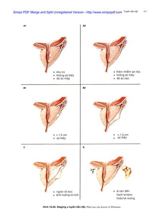 417Tuyeán tieàn lieät
Hình 10-26. Staging u tuyeán tieàn lieät. Phaân loaïi cuûa Jewett vaø Whitmore.
Simpo PDF Merge and Split Unregistered Version - http://www.simpopdf.com
 