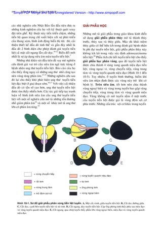 400 SIEÂU AÂM BUÏNG, CHAÄU VAØ NGÖÏC
caùc nhaø nghieân cöùu Nhaät Baûn laàn ñaàu tieân ñöa ra
nhöõng kinh nghieäm cuûa hoï vôùi kyõ thuaät queùt xoay
ñaët treân gheá. Kyõ thuaät naøy tieán trieån chaäm, nhöõng
tieán boä quan troïng chæ xuaát hieän vôùi söï phaùt trieån
cuûa thang xaùm, hình aûnh ñoäng hieån thò töùc thì, caûi
thieän thieát keá ñaàu doø tinh theå vaø gaàn ñaây nhaát laø
ñaàu doø 2 bình dieän cho pheùp ñaùnh giaù tuyeán tieàn
lieät caû maët caét ngang laãn caét doïc.10-12
Bieán ñoåi môùi
nhaát laø söï aùp duïng sieâu aâm maøu tuyeán tieàn lieät.7
Nhöõng nhaø khaûo saùt ñaàu tieân ñaõ say meâ nghieân
cöùu ñaùnh giaù vai troø cuûa sieâu aâm ngaû tröïc traøng ôû
beänh nhaân ung thö tuyeán tieàn lieät. Baùo caùo cuûa hoï
cho thaáy raèng ngay caû nhöõng ung thö nhoû cuõng taïo
neân vuøng taêng phaûn aâm.13-15
Nhöõng nghieân cöùu sau
ñoù laïi cho thaáy khoù phaùt hieän ung thö tuyeán tieàn
lieät ñaëc bieät ôû giai ñoaïn sôùm.16,17
Vôùi vieäc caûi thieän
ñaàu doø coù taàn soá cao hôn, ung thö tuyeán tieàn lieät
ñöôïc tìm thaáy nhieàu hôn. Caùc taùc giaû tieáp tuïc tranh
luaän veà hình aûnh sieâu aâm cuûa ung thö tuyeán tieàn
lieät vôùi moät soá nghieân cöùu moâ taû nhöõng toån thöông
nhoû giaûm phaûn aâm18
vaø moät soá khaùc moâ taû ung thö
lôùn coù phaûn aâm taêng.19
GIAÛI PHAÃU HOÏC
Nhöõng moâ taû giaûi phaãu trong giaùo khoa kinh ñieån
söû duïng giaûi phaãu phaân thuøy moâ taû thaønh thuøy
tröôùc, thuøy sau vaø thuøy giöõa. Maëc duø khaùi nieäm
thuøy giöõa coù theå höõu ích trong ñaùnh giaù beänh nhaân
bò phì ñaïi tuyeán tieàn lieät, giaûi phaãu phaân thuøy naøy
khoâng ích lôïi trong vieäc xaùc ñònh adenocarcinoma
tieàn lieät.20
Phaãu tích chi tieát tuyeán tieàn lieät cho thaáy
giaûi phaãu hoïc phaân vuøng, qua ñoù tuyeán tieàn lieät
ñöôïc chia thaønh 4 vuøng xung quanh nieäu ñaïo tieàn
lieät, vuøng ngoaïi vi, vuøng chuyeån tieáp, vuøng trung
taâm vaø vuøng tuyeán quanh nieäu ñaïo (Hình 10-1 ñeán
10-5). Tuy nhieân, ôû tuyeán bình thöôøng, hieám khi
sieâu aâm nhaän ñònh ñöôïc caùc vuøng naøy tröø khi coù
beänh lyù. Treân sieâu aâm, toát hôn neân chia thaønh
vuøng ngoaïi bieân vaø vuøng trong tuyeán bao goäp vuøng
chuyeån tieáp, vuøng trung taâm vaø vuøng quanh nieäu
ñaïo. Vuøng khoâng coù moâ tuyeán naèm ôû maët tröôùc
cuûa tuyeán tieàn lieät ñöôïc goïi laø vuøng ñeäm sôïi cô
phía tröôùc. Nhöõng caáu truùc sôïi cô khaùc trong tuyeán
Hình 10-1. Sô ñoà giaûi phaãu phaân vuøng tieàn lieät tuyeán. A, Maët caét vaønh, giöõa tuyeán tieàn lieät. B, Caét doïc ñöôøng giöõa.
C, Caét doïc, caïnh beân tuyeán tieàn lieät vaø tuùi tinh. D, Caét ngang, ñaùy tuyeán tieàn lieät. Caëp oáng phoùng tinh thaáy phía sau nieäu ñaïo
vaø vuøng tuyeán quanh nieäu ñaïo. E, Caét ngang, qua choùp tuyeán thaáy phaàn lôùn vuøng ngoaïi bieân, nieäu ñaïo vaø vuøng tuyeán quanh
nieäu ñaïo.
Simpo PDF Merge and Split Unregistered Version - http://www.simpopdf.com
 