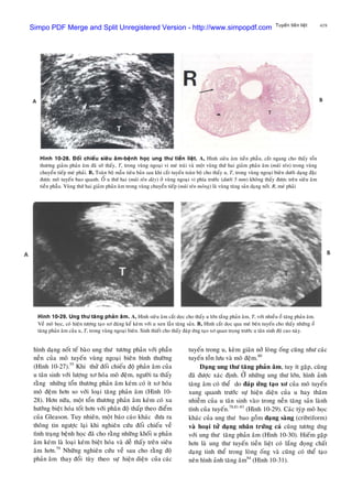 419Tuyeán tieàn lieät
hình daïng noát teá baøo ung thö töông phaûn vôùi phaàn
neàn cuûa moâ tuyeán vuøng ngoaïi bieân bình thöôøng
(Hình 10-27).55
Khi thöû ñoái chieáu ñoä phaûn aâm cuûa
u taân sinh vôùi löôïng xô hoùa moâ ñeäm, ngöôøi ta thaáy
raèng nhöõng toån thöông phaûn aâm keùm coù ít xô hoùa
moâ ñeäm hôn so vôùi loaïi taêng phaûn aâm (Hình 10-
28). Hôn nöõa, moät toån thöông phaûn aâm keùm coù xu
höôùng bieät hoùa toát hôn vôùi phaân ñoä thaáp theo ñieåm
cuûa Gleason. Tuy nhieân, moät baùo caùo khaùc ñöa ra
thoâng tin ngöôïc laïi khi nghieân cöùu ñoái chieáu veà
tình traïng beänh hoïc ñaõ cho raèng nhöõng khoái u phaûn
aâm keùm laø loaïi keùm bieät hoùa vaø deã thaáy treân sieâu
aâm hôn.79
Nhöõng nghieân cöùu veà sau cho raèng ñoä
phaûn aâm thay ñoåi tuøy theo söï hieän dieän cuûa caùc
Hình 10-28. Ñoái chieáu sieâu aâm-beänh hoïc ung thö tieàn lieät. A, Hình sieâu aâm tieàn phaãu, caét ngang cho thaáy toån
thöông giaûm phaûn aâm ñaõ sôø thaáy, T, trong vuøng ngoaïi vi meù traùi vaø moät vuøng thöù hai giaûm phaûn aâm (muõi teân) trong vuøng
chuyeån tieáp meù phaûi. B, Toaøn boä maãu tieâu baûn sau khi caét tuyeán toaøn boä cho thaáy u, T, trong vuøng ngoaïi bieân döôùi daïng ñaëc
ñöôïc moâ tuyeán bao quanh. OÅ u thöù hai (muõi teân daøy) ôû vuøng ngoaïi vi phía tröôùc (döôùi 5 mm) khoâng thaáy ñöôïc treân sieâu aâm
tieàn phaãu. Vuøng thöù hai giaûm phaûn aâm trong vuøng chuyeån tieáp (muõi teân moûng) laø vuøng taêng saûn daïng noát. R, meù phaûi
Hình 10-29. Ung thö taêng phaûn aâm. A, Hình sieâu aâm caét doïc cho thaáy u lôùn taéng phaûn aâm, T, vôùi nhieàu oå taêng phaûn aâm.
Veà moâ hoïc, coù hieän töôïng taïo xô ñaùng keå keøm vôùi u xen laãn taêng saûn. B, Hình caét doïc qua meù beân tuyeán cho thaáy nhöõng oå
taêng phaûn aâm cuûa u, T, trong vuøng ngoaïi bieân. Sinh thieát cho thaáy ñaùp öùng taïo xô quan troïng tröôùc u taân sinh ñoä cao naøy.
tuyeán trong u, keøm giaõn nôû loøng oáng cuõng nhö caùc
tuyeán toàn löu vaø moâ ñeäm.80
Daïng ung thö taêng phaûn aâm, tuy ít gaëp, cuõng
ñaõ ñöôïc xaùc ñònh. ÔÛ nhöõng ung thö lôùn, hình aûnh
taêng aâm coù theå do ñaùp öùng taïo xô cuûa moâ tuyeán
xung quanh tröôùc söï hieän dieän cuûa u hay thaâm
nhieãm cuûa u taân sinh vaøo trong neàn taêng saûn laønh
tính cuûa tuyeán.78,81-83
(Hình 10-29). Caùc tyùp moâ hoïc
khaùc cuûa ung thö bao goàm daïng saøng (cribriform)
vaø hoaïi töû daïng nhaân tröùng caù cuõng töông öùng
vôùi ung thö taêng phaûn aâm (Hình 10-30). Hieám gaëp
hôn laø ung thö tuyeán tieàn lieät coù laéng ñoïng chaát
daïng tinh theå trong loøng oáng vaø cuõng coù theå taïo
neân hình aûnh taêng aâm84
(Hình 10-31).
Simpo PDF Merge and Split Unregistered Version - http://www.simpopdf.com
 