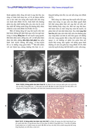 420 SIEÂU AÂM BUÏNG, CHAÄU VAØ NGÖÏC
Kinh nghieäm thaáy raèng chæ moät ít ung thö lôùn, lan
roäng coù hình aûnh taêng aâm, coù leõ do thaâm nhieãm
cuûa u taân sinh vaøo trong neàn tuyeán tieàn lieät taêng
saûn laønh tính (Hình 10-32). Sinh thieát toån thöông
phaûn aâm daøy döôùi höôùng daãn cuûa sieâu aâm laø caùch
duy nhaát ñeå chöùng minh raèng toån thöông thaáy ñöôïc
chính laø u taân sinh (Hình 10-29 ñeán 10-32).
Moät soá löôïng ñaùng keå ung thö tuyeán tieàn lieät
khoù hoaëc khoâng theå phaùt hieän qua sieâu aâm ngaû tröïc
traøng vì chuùng ñaúng aâm vôùi moâ tuyeán xung quanh.
Khi hieän dieän moät u ñoàng aâm, chæ coù theå phaùt hieän
ñöôïc khi thaáy nhöõng daáu hieäu thöù phaùt bao goàm
hình aûnh tuyeán khoâng ñoái xöùng, voû bao tuyeán
loài ra vaø nhöõng vuøng giaûm thaáu.75,85
Khi ñoái chieáu
vôùi moâ beänh hoïc, chuùng thöôøng lôùn hôn vaø coù
khuynh höôùng troän laãn vaøo moâ neàn taêng saûn (Hình
10-33).
Khaû naêng xaùc ñònh ung thö tuyeán tieàn lieät qua
thaêm tröïc traøng vaø qua sieâu aâm ñöôïc quyeát ñònh
bôûi khaû naêng phaân bieät moâ ung thö vôùi neàn moâ
bình thöôøng hoaëc taêng saûn. Khi moâ ung thö thay
theá hoaøn toaøn caû moät vuøng hay toaøn boä tuyeán, söï
phaân bieät trôû neân khoù khaên hôn. Xaùc ñònh ung thö
lan toûa phaûi döïa treân tính chaát sieâu aâm thöôøng gaëp
cuûa vuøng khaûo saùt hôn laø moái lieân quan vôùi nhöõng
caáu truùc xung quanh. Khi u thay theá toaøn boä vuøng
ngoaïi vi, noù thöôøng coù phaûn aâm giaûm hôn moâ
tuyeán beân trong, ñaûo ngöôïc vôùi töông quan bình
thöôøng veà sieâu aâm giöõa hai vuøng (Hình 10-34). Khi
toaøn boä tuyeán bò thay theá bôûi khoái u, treân neàn taêng
Hình 10-30. U taêng phaûn aâm keøm hoaïi töû. A, Hình caét maët vaønh qua phaàn giöõa cuûa tuyeán tieàn
lieät cho thaáy oå taêng phaûn aâm, *, ôû beân phaûi cuûa tuyeán. B, Queùt saùt döôùi vuøng treân cho thaáy khoái u vôùi
vuøng hoaïi töû trung taâm. Sinh thieát u cho hình aûnh comedocarcinoma keøm hoaïi töû.
Hình 10-31. U taêng phaûn aâm keøm caùc tinh theå. A, Hình caét ngang cho thaáy hình khuyeát sau
caét xuyeân nieäu ñaïo vaø ung thö giai ñoaïn A2 lan roäng vôùi nhieàu oå taêng phaûn aâm, T, xen laãn vôùi nhöõng
oå giaûm phaûn aâm, h, ôû phaàn trong cuûa tuyeán. B, Maãu moâ hoïc cho thaáy tích tuï nhieàu daïng tinh theå trong
loøng oáng thuoäc caùc tieåu thuøy u (muõi teân).
Simpo PDF Merge and Split Unregistered Version - http://www.simpopdf.com
 