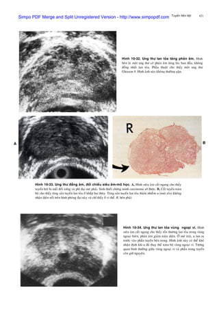 421Tuyeán tieàn lieät
Hình 10-32. Ung thö lan toûa taêng phaûn aâm. Hình
beân laø moät ung thö coù phaûn aâm taêng luùc ban ñaàu, khoâng
ñoàng nhaát lan toûa. Phaãu thuaät cho thaáy moät ung thö
Gleason 9. Hình aûnh naøy khoâng thöôøng gaëp.
Hình 10-33. Ung thö ñaúng aâm, ñoái chieáu sieâu aâm-moâ hoïc. A, Hình sieâu aâm caét ngang cho thaáy
tuyeán hôi bò maát ñoái xöùng vaø phì ñaïi meù phaûi. Sinh thieát chöùng minh carcinoma sôø ñöôïc. B, Caét tuyeán toaøn
boä cho thaáy taêng saûn tuyeán lan toûa ôû khaép hai thuøy. Taêng saûn tuyeán lan toûa thaâm nhieãm u (muõi teân) khoâng
nhaän dòeân noåi treân hình phoùng ñaïi naøy vaø chæ thaáy ôû vi theå. R, beân phaûi
Hình 10-34. Ung thö lan toûa vuøng ngoaïi vi. Hình
sieâu aâm caét ngang cho thaáy toån thöông lan toûa trong vuøng
ngoaïi bieân, phaûn aâm giaûm toaøn dieän. ÔÛ meù traùi, u lan ra
tröôùc vaøo phaàn tuyeán beân trong. Hình aûnh naøy coù theå khoù
nhaän ñònh khi u ñaõ thay theá toaøn boä vuøng ngoaïi vi. Töông
quan bình thöôøng giöõa vuøng ngoaïi vi vaø phaàn trong tuyeán
coøn giöõ nguyeân.
Simpo PDF Merge and Split Unregistered Version - http://www.simpopdf.com
 