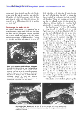 424 SIEÂU AÂM BUÏNG, CHAÄU VAØ NGÖÏC
nhöõng ngöôøi ñöôïc xaùc ñònh qua taàm soaùt. Vì vaäy,
coù khaû naêng taàm soaùt ñaõ phaùt hieän quaù möùc. Moät
thöû nghieäm môùi ñaây kieåm soaùt ngaãu nhieân ñaõ ñöôïc
khôûi ñoäng ñeå nghieân cöùu lieäu chôø ñôïi theo doõi
hoaëc ñieàu trò coù theå laøm thay ñoåi beänh söû töï nhieân
cuûa beänh naøy.97
Staging ung thö tuyeán tieàn lieät
Sau khi chaån ñoaùn ung thö TLT , khoâng theå ñöa ra
quyeát ñònh ñieàu trò thöïc söï tröø khi ñaõ xaùc ñònh ñöôïc
giai ñoaïn ung thö. Nhìn chung, ung thö phaùt hieän
tình côø trong khi caét tuyeán xuyeân nieäu ñaïo (trans-
urethral prostatectomy = TURP)(giai ñoaïn T1a) chæ
caàn theo doõi maø khoâng caàn ñieàu trò gì theâm. Ñeå
ñaùnh giaù nhöõng beänh nhaân naøy, ñeà nghò cho sieâu
aâm tuyeán tieàn lieät keøm sinh thieát coù höôùng daãn
thay vì phaûi caét laïi xuyeân nieäu ñaïo hoaëc sinh thieát
muø baèng kim. Thí duï, neáu tìm thaáy moät löôïng nhoû
ung thö treân maãu caét xuyeân nieäu ñaïo do chæ laáy
maãu taïi rìa khoái ung thö lôùn, sieâu aâm coù theå ñaùnh
giaù ñuùng ñaén vaø xaùc ñònh giai ñoaïn cuûa ung thö.98
Giai ñoaïn laâm saøng T1 vaø T2 coù theå ñöôïc ñieàu
trò baèng caùch caét boû toaøn boä tuyeán hay xaï trò.
Ngöôøi ta coøn baøn caõi veà caùch ñieàu trò toát nhaát cho
ung thö tuyeán tieàn lieät coù xaâm laán taïi choã (giai
ñoaïn T3). Neáu tìm thaáy xaâm laán vi theå, phaãu thuaät
roài xaï trò döôøng nhö laø caùch ñöôïc chaáp nhaän. Vôùi
xaâm laán ñaïi theå, phaãu thuaät coù veû khoâng ích lôïi gì
vaø ngöôøi ta khuyeân neân xaï trò. Staging baèng sieâu
aâm cho pheùp taùch bieät nhöõng beänh nhaân coù lan
roäng veà ñaïi theå taïi choã vaøo moâ môõ quanh tuyeán
tieàn lieät, tuùi tinh hoaëc haïch vuøng vôùi nhöõng beänh
nhaân coù beänh goùi goïn trong tuyeán (Hình 10-37).
Vai troø cuûa sieâu aâm trong staging taïi choã ñaõ
ñöôïc nhìn nhaän. Caùc nhaø nghieân cöùu ghi nhaän ñoä
nhaïy cao cho söï lan roäng taïi choã vaøo voû bao hoaëc
tuùi tinh laø 90% vaø thaáp laø töø 40% ñeán 60%.93,99
Quan troïng hôn, ñoä chuyeân bieät cuûa xaâm laán thay
ñoåi töø 46% ñeán 90%, tuøy thuoäc vaøo kích thöôùc u
nguyeân phaùt. Caùc u lôùn deã lan ra khoûi bao do maát
ñoái xöùng vaø voû bao khoâng ñeàu (Hình 10-35 vaø 10-
37). Tuy nhieân veà maët giaûi phaãu, tuyeán tieàn lieät
khoâng coù bao thaät söï maø chæ laø moät daûi sôïi cô.
Ñieàu naøy laøm cho caùc nhaø beänh hoïc vaø nieäu hoïc
phaân vaân trong vieäc xaùc ñònh söï chính xaùc cuûa ñoä
saâu xaâm laán ra ngoaøi khoûi daûi sôïi cô naøy vaøo moâ
meàm xung quanh tuyeán tieàn lieät.23
Hình 10-37. Ung thö tuyeán tieàn lieät phaùt hieän
tình côø treân beänh nhaân bò ung thö tröïc traøng.
Moät khoái u tuyeán tieàn lieät, T, khaùm thaáy khi sieâu aâm
trong tröïc traøng khaûo saùt ung thö tröïc traøng. Ung thö tröïc
traøng coøn ôû giai ñoaïn sôùm, nhöng ung thö tieàn lieät ñoøi
hoûi phaûi xaï trò. Noù ôû giai ñoaïn T3 (Trích töø Bree RL.
Ultrasound imaging of rectal and perirectal
abnormalities. In Thrall JH. Ed. Current practice of
Radiology. St Louis:Mosby Year Book; 1993.) Treân sieâu aâm coù theå xaùc ñònh söï lan roäng toån
Hình 10-38. Xaâm laán tuùi tinh. A, Hình caét doïc beân phaûi cho thaáy tuùi tinh beân phaûi bình
thöôøng, S. B, Hình caét doïc meù traùi cho thaáy u lôùn, T, lan roäng vaøo trong tuùi tinh traùi, S, laøm maát
hình nhoïn cuûa tuùi tinh.
Simpo PDF Merge and Split Unregistered Version - http://www.simpopdf.com
 