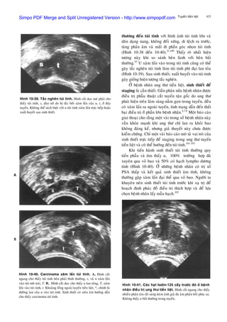 425Tuyeán tieàn lieät
thöông ñeán tuùi tinh vôùi hình aûnh tuùi tinh lôùn vaø
daõn daïng nang, khoâng ñoái xöùng, di leäch ra tröôùc,
taêng phaûn aâm vaø maát ñi phaàn goùc nhoïn tuùi tinh
(Hình 10-38 ñeán 10-40).21,100
Thaáy roõ nhaát hieän
töôïng naøy khi so saùnh beân laønh vôùi beân baát
thöôøng.93
U xaâm laán vaøo trong tuùi tinh cuõng coù theå
gaây taéc ngheõn tuùi tinh laøm tuùi tinh phì ñaïi lan toûa
(Hình 10-39). Sau sinh thieát, xuaát huyeát vaøo tuùi tinh
gaây gioáng hieän töôïng taéc ngheõn.
ÔÛ beänh nhaân ung thö tieàn lieät, sinh thieát ñeå
staging laø caàn thieát. Gaàn phaân nöûa beänh nhaân ñöôïc
ñieàu trò phaãu thuaät caét tuyeán taän goác do ung thö
phaùt hieän treân laâm saøng-naèm goïn trong tuyeán, ñeàu
coù xaâm laán ra ngoaøi tuyeán, tình traïng daãn ñeán thaát
baïi ñieàu trò ôû phaàn lôùn beänh nhaân.4,7,8
Moät baùo caùo
giai thoaïi cho raèng moät vaøi trong soá beänh nhaân naøy
vaãn khoûe maïnh khi ung thö chæ lan ra khoûi bao
khoâng ñaùng keå, nhöng giaû thuyeát naøy chöa ñöôïc
kieåm chöùng. Chæ moät vaøi baùo caùo moâ taû vai troø cuûa
sinh thieát tröïc tieáp ñeå staging trong ung thö tuyeán
tieàn lieät vaø coù theå höôùng ñeán tuùi tinh.101-103
Hình 10-39. Taéc ngheõn tuùi tinh. Hình caét doïc meù phaûi cho
thaáy tuùi tinh, s, daõn nôû do bò taéc bôûi xaâm laàn cuûa u, t, ôû ñaùy
tuyeán. Khoâng theå taùch bieät vôùi u tuùi tinh xaâm laán tröïc tieáp hoaëc
xuaát huyeát sau sinh thieát.
Khi tieán haønh sinh thieát tuùi tinh thöôøng quy
tieàn phaãu vaø tìm thaáy u, 100% tröôøng hôïp ñaõ
xuyeân qua voû bao vaø 50% coù haïch lympho döông
tính (Hình 10-40). ÔÛ nhöõng beänh nhaân coù trò soá
PSA thaáp vaø keát quaû sinh thieát aâm tính, khoâng
thöôøng gaëp xaâm laán ñaïi theå qua voû bao. Ngöôøi ta
khuyeân neân sinh thieát tuùi tinh tröôùc khi xaï trò ñeå
hoaïch ñònh phaùc ñoà ñieàu trò thích hôïp vaø ñeå löïa
choïn beänh nhaân laáy maãu haïch.102
Hình 10-40. Carcinoma xaâm laán tuùi tinh. A, Hình caét
ngang cho thaáy tuùi tinh beân phaûi bình thöôøng, s, vaø u xaâm laán
vaøo tuùi tnh traùi, T. B, Hình caét doïc cho thaáy u lan roäng, T, xaâm
laán vaøo tuùi tinh, t. Khoaûng loàng ngoaøi tuyeán tieàn lieät, *, chính laø
ñöôøng lan cuûa u vaøo tuùi tinh. Sinh thieát coù sieâu aâm höôùng daãn
cho thaáy carcinoma tuùi tinh.
Hình 10-41. Caùc haït Iodin-125 caáy tröôùc ñoù ôû beänh
nhaân ñieàu trò ung thö tieàn lieät. Hình caét ngang cho thaáy
nhieàu phaûn aâm raát saùng keøm aûnh giaû ña aâm phaûn hoài phía xa.
Khoâng thaáy u baát thöôøng trong tuyeán.
Simpo PDF Merge and Split Unregistered Version - http://www.simpopdf.com
 