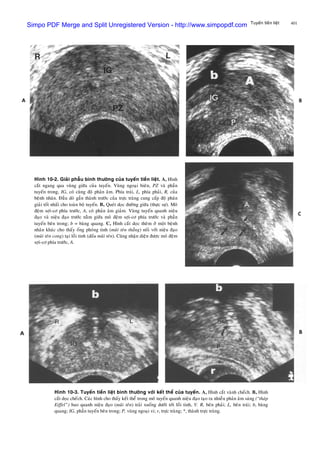 401Tuyeán tieàn lieät
Hình 10-2. Giaûi phaãu bình thöôøng cuûa tuyeán tieàn lieät. A, Hình
caét ngang qua vuøng giöõa cuûa tuyeán. Vuøng ngoaïi bieân, PZ vaø phaàn
tuyeán trong, IG, coù cuøng ñoä phaûn aâm. Phía traùi, L, phía phaûi, R, cuûa
beänh nhaân. Ñaàu doø gaàn thaønh tröôùc cuûa tröïc traøng cung caáp ñoä phaân
giaûi toát nhaát cho toaøn boä tuyeán. B, Queùt doïc ñöôøng giöõa (thöïc söï). Moâ
ñeäm sôïi-cô phía tröôùc, A, coù phaûn aâm giaûm. Vuøng tuyeán quanh nieäu
ñaïo vaø nieäu ñaïo tröôùc naèm giöõa moâ ñeäm sôïi-cô phía tröôùc vaø phaàn
tuyeán beân trong; b = baøng quang. C, Hình caét doïc theâm ôû moät beänh
nhaân khaùc cho thaáy oáng phoùng tinh (muõi teân thaúng) noái vôùi nieäu ñaïo
(muõi teân cong) taïi loài tinh (ñaàu muõi teân). Cuõng nhaän dieän ñöôïc moâ ñeäm
sôïi-cô phía tröôùc, A.
Hình 10-3. Tuyeán tieàn lieät bình thöôøng vôùi keát theå cuûa tuyeán. A, Hình caét vaønh cheách. B, Hình
caét doïc cheách. Caùc hình cho thaáy keát theå trong moâ tuyeán quanh nieäu ñaïo taïo ra nhieàu phaûn aâm saùng (“thaùp
Eiffel”) bao quanh nieäu ñaïo (muõi teân) traûi xuoáng döôùi tôùi loài tinh, V. R, beân phaûi; L, beân traùi; b, baøng
quang; IG, phaàn tuyeán beân trong; P, vuøng ngoaïi vi; r, tröïc traøng; *, thaønh tröïc traøng.
Simpo PDF Merge and Split Unregistered Version - http://www.simpopdf.com
 