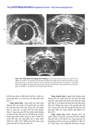 402 SIEÂU AÂM BUÏNG, CHAÄU VAØ NGÖÏC
tieàn lieät bao goàm cô thaét tröôùc tieàn lieät, cô thaét sau
tuyeán tieàn lieät vaø cô trôn doïc cuûa ñoaïn gaàn nieäu
ñaïo.21-23
Vuøng ngoaïi bieân, vuøng tuyeán lôùn nhaát chöùa
khoaûng 70% moâ tuyeán vaø laø nguoàn goác cuûa phaàn
lôùn ung thö tuyeán tieàn lieät. Vuøng naøy bao quanh
ñoaïn xa nieäu ñaïo vaø ngaên caùch vôùi vuøng chuyeån
tieáp vaø vuøng trung taâm bôûi bao phaãu thuaät thöôøng
coù phaûn aâm daøy, keát quaû cuûa keát theå hoaëc voâi hoùa.
Vuøng ngoaïi bieân chieám vuøng sau, beân vaø ñænh cuûa
tuyeán tieàn lieät, traûi roäng phaàn naøo ra phía tröôùc
(Hình 10-1 ñeán 10-5). Nhöõng oáng daãn trong vuøng
ngoaïi bieân ñoå vaøo nieäu ñaïo ñoaïn xa.
Hình 10-4. Giaûi phaãu caét ngang bình thöôøng treân beänh nhaân taêng saûn laønh tính tuyeán tieàn lieät
(BPH). A, Tuùi tinh,*, laø caëp phaûn aâm keùm hieän leân döôùi daïng nhöõng caáu truùc nhieàu vaùch ngaên bao xung
quanh tröïc traøng, r, muõi teân laø ñaàu doø xoay troøn. B, Ñaùy cuûa tuyeán tieàn lieät. A, adenoma; *, bao phaãu
thuaät; muõi teân ngaén, oáng phoùng tinh; muõi teân daøi, nieäu ñaïo. C, Phía döôùi uï nuùi laø nieäu ñaïo (muõi teân) naèm ôû
phía sau do BPH. *, caùc maïch maùu noåi roõ quanh tuyeán tieàn lieät.
Vuøng chuyeån tieáp ôû ngöôøi bình thöôøng chöùa
khoaûng 5% moâ tuyeán tieàn lieät. Noù hieän leân döôùi
daïng hai vuøng tuyeán nhoû naèm caïnh nieäu ñaïo ñoaïn
gaàn. Ñaây laø vò trí phaùt sinh taêng saûn laønh tính tuyeán
tieàn lieät. Nhöõng oáng trong vuøng chuyeån tieáp keát
thuùc ôû ñoaïn gaàn nieäu ñaïo ngang loài tinh, töùc ranh
giôùi phía döôùi cuûa vuøng chuyeån tieáp (Hình 10-1
ñeán 10-5).
Vuøng trung taâm chieám khoaûng 25% moâ
tuyeán. Naèm ôû vuøng ñaùy cuûa tuyeán tieàn lieät. Nhöõng
oáng daãn tinh vaø tuùi tinh ñi vaøo vuøng trung taâm vaø
oáng phoùng tinh ñi xuyeân qua noù (Hình 10-1 ñeán 10-
5). Vuøng trung taâm töông ñoái ñeà khaùng vôùi quaù
Simpo PDF Merge and Split Unregistered Version - http://www.simpopdf.com
 