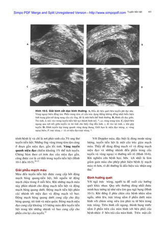 403Tuyeán tieàn lieät
trình beänh lyù vaø chæ laø nôi phaùt sinh cuûa 5% ung thö
tuyeán tieàn lieät. Nhöõng oáng vuøng trung taâm taän cuøng
ôû ñoaïn gaàn nieäu ñaïo, gaàn loài tinh. Vuøng tuyeán
quanh nieäu ñaïo chieám khoaûng 1% theå tích tuyeán.
Chuùng baùm theo cô trôn doïc cuûa nieäu ñaïo gaàn,
cuõng ñöôïc coi laø cô thaét trong tuyeán tieàn lieät (Hình
10-1 ñeán 10-5).20-22
Giaûi phaãu maïch maùu
Maùu ñeán tuyeán tieàn lieät ñöôïc cung caáp bôûi ñoäng
maïch baøng quang-tieàn lieät, baét nguoàn töø ñoäng
maïch chaäu trong ôû moãi beân. Khi nhöõng maïch maùu
naøy phaân nhaùnh cho ñoäng maïch tieàn lieät vaø ñoäng
maïch baøng quang döôùi. Ñoäng maïch tieàn lieät phaân
caùc nhaùnh tôùi nieäu ñaïo vaø ñoäng maïch voû bao.
Ñoäng maïch baøng quang döôùi cung caáp cho ñaùy
baøng quang, tuùi tinh vaø nieäu quaûn. Ñoäng maïch nieäu
ñaïo cung caáp khoaûng 1/3 löôïng maùu ñeán tuyeán tieàn
lieät trong khi nhöõng nhaùnh voû bao cung caáp cho
phaàn coøn laïi cuûa tuyeán.23
Hình 10-5. Giaûi bình caét doïc bình thöôøng. A, Ñaàu doø beân queùt beân tuyeán phì ñaïi nheï.
Vuøng ngoaïi bieân ñaúng aâm. Phaàn trung taâm coù caáu truùc daïng thaúng khoâng ñoàng nhaát bieåu hieän
tình traïng giaõn nôû daïng nang cuûa caùc oáng, ñoù laø moät bieán theå bình thöôøng. B, Hình caét doïc giöõa.
Tuùi tinh, S, traûi vaøo trong tuyeán tieàn lieät taïo thaønh hình moû, *; cz, vuøng trung taâm. C, Queùt beân
ngang qua nôi noái giöõa tuyeán vaø tuùi tinh cho thaáy oáng daãn tinh, v, ñi vaøo tuùi tinh, s, khi gaëp
tuyeán. D, Ñænh tuyeán taäp trung quanh vuøng daïng thang. Giôùi haïn laø nieäu ñaïo maøng, u; vuøng
ngoaïi bieân, P; tröïc traøng, r vaø cô nieäu ñaïo-tröïc traøng, *.
Vôùi Doppler maøu, ñaëc bieät laø duøng mode naêng
löôïng, tuyeán tieàn lieät laø moät caáu truùc giaøu maïch
maùu. Thaáy deã daøng ñoäng maïch voû vaø ñoäng maïch
nieäu ñaïo vaø nhöõng nhaùnh ñeán phaàn trong cuûa
tuyeán vaø vuøng ngoaïi vi thöôøng noåi roõ (Hình 10-6).
Khi nghieân cöùu beänh hoïc, höõu ích nhaát laø laøm
giaûm gain maøu cho pheùp phaùt hieän beänh lyù maïch
maùu roõ hôn, vì ñoù thöôøng laø daáu hieäu xaùc nhaän ung
thö.7
Ñònh höôùng queùt
Vôùi ngaû tröïc traøng, ngöôøi ta ñeà xuaát caùc höôùng
queùt khaùc nhau. Quy öôùc thöôøng duøng nhaát ñöôïc
minh hoïa töông töï nhö sieâu aâm qua ngaû buïng (Hình
10-1). Khi ñöùng ôû phía chaân cuûa beänh nhaân naèm
ngöûa, nhìn leân, tröïc traøng naèm ôû phaàn döôùi maøn
hình vôùi chuøm soùng sieâu aâm phaùt ra töø beân trong
tröïc traøng. Treân hình caét ngang, thaønh buïng tröôùc
naèm ôû phaàn treân cuûa maøn hình vôùi beân phaûi cuûa
beänh nhaân ôû beân traùi cuûa maøn hình. Treân maët caét
Simpo PDF Merge and Split Unregistered Version - http://www.simpopdf.com
 