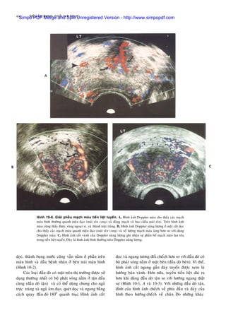 SIEÂU AÂM BUÏNG, CHAÄU VAØ NGÖÏC404
doïc, thaønh buïng tröôùc cuõng vaãn naèm ôû phaàn treân
maøn hình vaø ñaàu beänh nhaân ôû beân traùi maøn hình
(Hình 10-2).
Caùc loaïi ñaàu doø coù maët treân thò tröôøng ñöôïc söû
duïng thöôøng nhaát coù boä phaùt soùng naèm ôû taän ñaàu
cuøng (ñaàu doø taän) vaø coù theå duøng chung cho ngaû
tröïc traøng vaø ngaû aâm ñaïo, queùt doïc vaø ngang baèng
caùch quay ñaàu doø 1800
quanh truïc. Hình aûnh caét
Hình 10-6. Giaûi phaãu maïch maùu tieàn lieät tuyeán. A, Hình aûnh Doppler maøu cho thaáy caùc maïch
maùu bình thöôøng quanh nieäu ñaïo (muõi teân cong) vaø ñoäng maïch voû bao (ñaàu muõi teân). Treân hình aûnh
maøu cuõng thaáy ñöôïc vuøng ngoaïi vi, vaø thaønh tröïc traøng. B, Hình aûnh Doppler naêng löôïng ôû maët caét doïc
cho thaáy caùc maïch maùu quanh nieäu ñaïo (muõi teân cong) vaø soá löôïng maïch maùu taêng hôn so vôùi duøng
Doppler maøu. C, Hình aûnh caét vaønh cuûa Doppler naêng löôïng ghi nhaän söï phaân boá maïch maùu lan toûa
trong tieàn lieät tuyeán. Ñaây laø hình aûnh bình thöôøng treân Doppler naêng löôïng.
doïc vaø ngang töông ñoái cheách hôn so vôùi ñaàu doø coù
boä phaùt soùng naèm ôû maët beân (ñaàu doø beân). Vì theá,
hình aûnh caét ngang gaàn ñaùy tuyeán ñöôïc xem laø
höôùng baùn vaønh. Hôn nöõa, tuyeán tieàn lieät daøi ra
hôn khi duøng ñaàu doø taän so vôùi höôùng ngang thaät
söï (Hình 10-1, A vaø 10-3). Vôùi nhöõng ñaàu doø taän,
ñænh cuûa hình aûnh cheách veà phía ñaàu vaø ñaùy cuûa
hình theo höôùng cheách veà chaân. Do nhöõng khaùc
Simpo PDF Merge and Split Unregistered Version - http://www.simpopdf.com
 