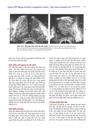 405Tuyeán tieàn lieät
bieät cuûa caáu truùc ñaàu doø, giaûi phaãu coù theå thay ñoåi
töø maùy naøy ñeán maùy khaùc.
Giaûi phaãu caét ngang vaø caét vaønh
Tuùi tinh ñöôïc thaáy ôû hai beân, töông ñoái phaûn aâm
giaûm, caáu truùc nhieàu vaùch ngaên bao quanh tröïc
traøng ôû phía treân ñeán ñaùy cuûa tuyeán tieàn lieät (xem
Hình 10-1, 10-4, A, vaø 10-5, B vaø C). Treân maët caét
ngang, nieäu ñaïo tröôùc, cô trôn vaø vuøng tuyeán bao
quanh noù coù phaûn aâm töông ñoái keùm (Hình 10-6,
B). Treân hình caét vaønh, choã noái cuûa vuøng quanh
nieäu ñaïo giaûm phaûn aâm vôùi loài tinh taïo hình aûnh
gioáng thaùp Eiffel (Hình 10-7, A).20
Vuøng trong cuûa
tuyeán ngaên caùch vôùi vuøng ngoaïi bieân bôûi bao phaãu
thuaät. Ñoâi khi coù theå thaáy bao naøy ôû tuyeán tieàn lieät
bình thöôøng. Thöôøng thì keát theå, nhaän thaáy nhö
nhöõng oå taêng aâm, phaùt trieån ngang bao phaãu thuaät
(Hình 10-4, B, vaø 10-6, B). Thoâng thöôøng söï ngaên
caùch giöõa caùc vuøng naøy thaáy ñöôïc treân hình caét
ngang chæ coù tính caùch döïa theo vò trí chöù khoâng coù
nhöõng caáu truùc rieâng bieät ñeå laøm saùng toû giaûi phaãu
(Hình 10-2).
Giaûi phaãu caét doïc
Phaàn lôùn nhöõng hình aûnh beân cuûa tuyeán tieàn lieät ôû
maët caét doïc cho thaáy moâ vuøng ngoaïi bieân coù tính
aâm ñoàng nhaát. Trong taêng saûn tuyeán, vuøng chuyeån
tieáp coù theå traûi roäng ra phía beân, eùp vaøo vuøng
ngoaïi bieân naèm phía sau (Hình 10-7, B). ÔÛ ñaùy cuûa
Hình 10-7. Taêng saûn laønh tính tieàn lieät tuyeán. A, Hình aûnh caét vaønh tieàn lieät tuyeán treân beänh
nhaân coù taêng saûn. Vuøng taêng saûn bao xung quanh nieäu ñaïo ,U, lan toûa ñeán vuøng chuyeån tieáp. Vuøng
neàn cuûa nieäu ñaïo môû roäng, *, taïo neân hình aûnh “thaùp Eiffel”.
tuyeán, tuùi tinh ôû ngay saùt vuøng trung taâm vaø vuøng
ngoaïi vi (Hình 10-5, B). Khi keát theå tuyeán chieám
vuøng tuyeán quanh nieäu ñaïo, chuùng coù theå taïo neân
hình aûnh daïng thaúng taêng phaûn aâm (Hình 10-5, B).
Nôi tuùi tinh vaø oáng daãn tinh ñi vaøo vuøng trung taâm
taïo neân moät khoang loàng ngoaøi tuyeán tieàn lieät, laø
loä trình maø u taân sinh xaâm laán töø tuyeán tieàn lieät
vaøo tuùi tinh. Nôi tuùi tinh vaø oáng daãn tinh ñi vaøo
vuøng trung taâm cuõng taïo neân hình aûnh daïng moû
chim, coù phaûn aâm keùm (Hình 10-5, B vaø C). OÁng
phoùng tinh ñoâi khi coù theå nhìn thaáy chaïy töø tuùi tinh
qua vuøng trung taâm vaø nhaäp vaøo nieäu ñaïo ôû ngang
uï nuùi khi noù traûi töø vò trí phía tröôùc ra phía sau hôn
(Hình 10-2, C). Nieäu ñaïo vaø caùc tuyeán bao quanh
vaø cô trôn thöôøng cho phaûn aâm keùm (Hình 10-2, B
vaø 10-7, B) nhöng khi hieän dieän keát theå, chuùng coù
theå coù phaûn aâm daøy (Hình 10-3, B vaø 10-5, B). Coù
theå thaáy deã daøng moâ ñeäm sôïi-cô phía tröôùc treân
hình caét doïc ôû phía tröôùc nieäu ñaïo (Hình 10-2, C).
Voû bao tuyeán tieàn lieät
Treân hình caét ngang vaø doïc, ñöôøng bôø cuûa tuyeán
tieàn lieät vôùi lôùp môõ bao quanh coù theå laø roõ neùt,
hoaëc ñoâi khi keùm roõ hôn ñaëc bieät ôû vuøng xa ñaàu doø
hoaëc treân phaàn rìa cuûa tröôøng hình. Veà maët moâ
hoïc, voû bao khoâng roõ neùt vaø coù caùc maïch maùu,
thaàn kinh ñi qua vuøng moâ quanh tieàn lieät, bao goàm
cô trôn, cô boä xöông vaø moâ lieân keát loûng leõo. ÔÛ
maët sau, moâ quanh tuyeán laø sôïi-môõ vaø khoâng toàn
Simpo PDF Merge and Split Unregistered Version - http://www.simpopdf.com
 