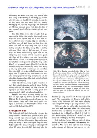 407Tuyeán tieàn lieät
baát thöôøng khi khaùm laâm saøng cuõng nhö ñeå ñaûm
baûo khoâng coù baát thöôøng ôû tröïc traøng gaây caûn trôû
cho vieäc sieâu aâm. Sau khi boâi trôn ñaày ñuû, ñöa ñaàu
doø nheï nhaøng vaøo tröïc traøng. Vieäc naøy thöôøng
khoâng gaây ñau, ñaëc bieät ôû ngöôøi giaø khi tröông löïc
cô thaét tröïc traøng ñaõ giaûm. Hình aûnh ghi nhaän töø
maùy cho thaáy tuyeán tieàn lieät ôû nhieàu goùc ñoä khaùc
nhau.
Khi thaêm khaùm tuyeán tieàn lieät, caàn ñaùnh giaù
moät caùch heä thoáng. Neáu baét ñaàu ôû ñöôøng caét ngang
hoaëc baùn vaønh, tuùi tinh hieän leân ôû phaàn treân cuûa
tuyeán tieàn lieät, phía treân ñaùy. Caëp caáu truùc naøy coù
theå khaùc nhau veà kích thöôùc vaø hình daïng, phuï
thuoäc vaøo tuoåi vaø hoaït ñoäng tình duïc. Chuùng
thöôøng cho phaûn aâm keùm, khoâng ñeàu vaø thöôøng
ñoái xöùng (Hình 10-4, A). Tieáp tuïc maët caét ngang
hoaëc baùn vaønh, khaûo saùt ñaùy tuyeán tieàn lieät vôùi
vuøng trung taâm, chuyeån tieáp vaø vuøng tuyeán quanh
nieäu ñaïo. Moâ ñeäm sôïi-cô ôû phía tröôùc cho phaûn aâm
keùm. ÔÛ maët caét baùn vaønh, vuøng quanh nieäu ñaïo coù
theå coù phaûn aâm raát giaûm vaø gioáng nhö vuøng khieám
khuyeát caét boû qua nieäu ñaïo (Hình 10-7, A). Coù theå
nhaän dieän ñöôïc nieäu ñaïo vaø oáng phoùng tinh. Ngang
uï nuùi, oáng phoùng tinh vaø nieäu ñaïo laãn vaøo nhau.
Gaàn vuøng ñænh cuûa tuyeán, phaàn lôùn moâ thuoäc vuøng
ngoaïi bieân. ÔÛ tuyeán tieàn lieät bình thöôøng, khoù phaân
chia vuøng ngoaïi vi vôùi vuøng trong tuyeán. Chæ khi
naøo nhaän ñònh ñöôïc bao phaãu thuaät môùi coù theå taùch
bieät ñöôïc hai vuøng naøy.
Treân maët caét doïc, xoay töø phaûi sang traùi seõ
thaáy ñöôïc söï ñoái xöùng cuûa tuyeán vaø khaúng ñònh laïi
nhöõng nghi ngôø baát thöôøng ñaõ thaáy treân maët caét
ngang vaø caét vaønh. Tuùi tinh vaø vuøng quanh nieäu
ñaïo ñöôïc ñaùnh giaù toát hôn treân ñöôøng caét doïc.
Doppler maøu ñöôïc söû duïng thöôøng qui, ñaëc
bieät khi nghi ngôø ung thö vaø döï ñònh sinh thieát.
Phaûi caøi ñaët ñoä nhaïy cuûa maøu vaø möùc gain sao cho
bình thöôøng khoâng thaáy ñöôïc maïch maùu vuøng
ngoaïi vi. Nhö vaäy, khi thaáy taêng tuaàn hoaøn, coù theå
nghi ngôø baát thöôøng (Hình 10-9).
Kyõ thuaät sinh thieát
Thuû thuaät sinh thieát döôùi höôùng daãn cuûa sieâu aâm
cuøng vôùi khaûo saùt chaån ñoaùn goùp theâm phaàn quan
troïng vaøo lónh vöïc sieâu aâm tuyeán tieàn lieät. Sinh
thieát tuyeán tieàn lieät thoâng thöôøng duøng ngoùn tay ôû
trong tröïc traøng vaø kim ñaâm xuyeân taàng sinh moân
hoaëc xuyeân tröïc traøng. Söû duïng sieâu aâm ngaû tröïc
traøng ñeå höôùng daãn sinh thieát ñöôïc thöïc hieän laàn
Hình 10-9. Doppler maøu tyeán tieàn lieät. A, Hình
Doppler maøu moät ung thö nhoû tieàn lieät. Ung thö ñoàng phaûn
aâm, naèm ôû ñaùy tuyeán. Soá löôïng maïch maùu gia taêng laøm
nghi ngôø ung thö vaø sinh thieát cho thaáy ung thö Gleason 7.
Löu yù phaàn coøn laïi cuûa vuøng ngoaïi vi khoâng coù maïch maùu,
nhôø vaäy quan saùt ñöôïc roõ vuøng u giaøu maïch maùu. B, Hình
Doppler maøu qua vuøng giöõa tuyeán tieàn lieät cho thaáy taêng
sinh maïch maùu ôû vuøng ngoaïi bieân meù traùi keøm moät khoái
giaûm phaûn aâm, h, bieåu hieän cuûa carcinoma nhaân tröùng caù
(comedocarcinoma) Gleason 6. Khoâng thaáy vuøng taêng
maïch naøo khaùc. Löu yù neàn taêng phaûn aâm phuø hôïp vôùi
comedocarcinom.
ñaàu tieân qua taàng sinh moân vôùi ñaàu doø xoay quanh
truïc.25
Nhieàu nhaø nghieân cöùu ñaõ moâ taû kinh nghieäm
cuûa hoï veà kyõ thuaät sinh thieát döôùi höôùng daãn cuûa
sieâu aâm ngaû tröïc traøng vaø qua taàng sinh moân.20,26,27
Hieän nay sieâu aâm höôùng daãn sinh thieát ñöôïc
thöïc hieän ngaû qua tröïc traøng. Heä thoáng höôùng
daãn kim ñöôïc keïp treân maët beân cuûa ñaàu doø ñoái vôùi
loaïi ñaàu doø taän vaø ñaàu doø beân (Hình 10-8; Hình 10-
10). Nhöõng ñöôøng daãn ñieän töû cho thaáy loä trình
kim (Hình 10-11) giuùp thuû thuaät deã daøng hôn.
Sinh thieát tuyeán tieàn lieät qua ngaû tröïc traøng
thöôøng thöïc hieän vôùi suùng sinh thieát töï ñoäng, loaïi
kim 18-G. Nhö vaäy laø thöïc hieän sinh thieát loõi baèng
nhöõng thao taùc toái thieåu, söï chaáp nhaän roõ reät cuûa
Simpo PDF Merge and Split Unregistered Version - http://www.simpopdf.com
 