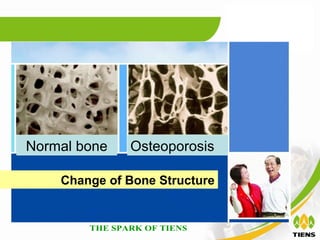 Normal bone   Osteoporosis

    Change of Bone Structure
 
