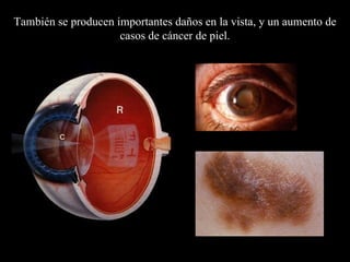 También se producen  importantes daños en la vista, y un aumento de casos de cáncer de piel. 