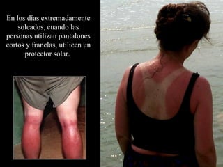 En los días extremadamente soleados, cuando las personas utilizan pantalones cortos y franelas, utilicen un protector solar.   
