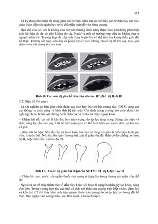 119
Là kỹ thuật phát hiện rất nhạy giãn đài bể thận. Siêu âm có thể thấy sỏi bể thận hay sỏi niệu
quản đoạn đầu niệu quản hay sỏi ở chỗ niệu quản đỗ vào bàng quang.
Hạn chế của siêu âm là không cho biết tổn thương chức năng thận. Siêu âm không phân biệt
giãn bể thận do tắc và giãn không do tắc. Ngoài ra một số trường hợp siêu âm không tìm ra
nguyên nhân tắc. Trường hợp tắc cấp tính trong 6 giờ đầu có thể siêu âm không thấy giãn đài
bể thận. Thường kết hợp siêu âm và phim hệ tiết niệu không chuẩn bị để tìm sỏi, hiệu quả
chẩn đoán hội chứng tắc cao hơn.
Hình 10. Các mức độ giãn bể thận trên siêu âm: BT, độ I, độ II, độ III
2.2. Niệu đồ tĩnh mạch
Là xét nghiệm cơ bản giúp chẩn đoán xác định hay loại trừ hội chứng tắc. NĐTM cung cấp
các thông tin chức năng và hình thái hệ tiết niệu. Chỉ định trong trường hợp chẩn đoán còn
nghi ngờ hoặc là đối với những bệnh nhân có chỉ định can thiệp ngoại khoa.
+ Chậm bài tiết: có thể là kín đáo hay trầm trọng, do áp lực tăng trong đường dẫn niệu và
chức năng lọc cầu thận suy. Đài bể thận niệu quản có thể hiện hình sau nhiều phút, có khi sau
24 giờ.
+ Giãn đài bể thận: Nếu tắc cấp và hoàn toàn, đài thận sẽ căng mà giãn ít, biểu hiện hình góc
tròn: ứ nước độ I. Nếu tắc lâu ngày đường bài xuất sẽ giãn lớn, đài thận có đáy phẳng: ứ nước
độ II, hoặc hình cầu: ứ nước độ III.
Hình 11. 3 mức độ giãn đài thận trên NĐTM: BT, độ I, độ II, độ III
+ Chậm bài xuất: nước tiểu ngấm thuốc cản quang ứ đọng lâu trong đường dẫn niệu trên chỗ
tắc.
Ngoài ra có thể thấy thêm một số dấu hiệu khác: sỏi hoặc là nguyên nhân gây tắc khác, bóng
thận lớn. Trong trường hợp tắc cấp tính sẽ thấy mô thận cản quang xuất hiện chậm, đậm dần
và kéo dài. Có thể thấy hình ảnh trào ngược thuốc cản quang do có áp lực cao trong đài bể
thận: trào ngược vào xoang thận, vào tĩnh mạch, vào bạch mạch.
 