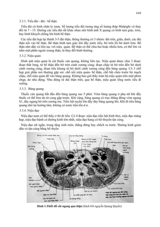 110
3.3.1. Tiểu đài - đài - bể thận
Tiểu đài có hình chân ly rượu. Số lượng tiểu đài tương ứng số lượng tháp Malpighi và thay
đổi từ 7 - 15. Hướng các tiểu đài rất khác nhau nên hình ảnh X quang có hình tam giác, tròn,
hay hình khuyết chồng lên hình bể thận.
Các tiểu đài họp lại thành 3-5 đài thận, thông thường có 3 nhóm: đài trên, giữa, dưới; các đài
thận nối vào bể thận. Bể thận hình tam giác khi đầy nước tiểu, bờ trên lồi bờ dưới lỏm. Bể
thận nhỏ dần và liên tục với niệu quản. Bể thận có thể chia hai hoặc nhiều hơn, có thể lớn và
nằm một phần ngoài xoang thận, là thay đỗi bình thường.
3.3.2. Niệu quản
Hình ảnh niệu quản là cột thuốc cản quang, không liên tục. Niệu quản được chia 3 đoạn:
đoạn thắt lưng, từ bể thận đến bờ trên cánh xương cùng; đoạn chậu từ bờ trên đến bờ dưới
cánh xương cùng, đoạn tiểu khung từ bờ dưới cánh xương cùng đến bàng quang. Có 3 chỗ
hẹp giải phẫu nơi thường gặp sỏi: chỗ nối niệu quản- bể thận, chỗ bắt chéo trước bó mạch
chậu, chỗ niệu quản đổ vào bàng quang. Không bao giờ thấy toàn bộ niệu quản trên một phim
chụp, do nhu động. Nhu động từ đài thận trên, qua bể thận, niệu quản tống nước tiểu đi
xuống.
3.3.3. Bàng quang
Thuốc cản quang bắt đầu đến bàng quang sau 5 phút. Vòm bàng quang ở phụ nữ khi đầy
thuốc có thể lỏm do tử cung gập trước. Khi căng, bàng quang có trục thẳng đứng vòm ngang
S1, đáy ngang bờ trên xương mu. Tiền liệt tuyến lớn đẩy đáy bàng quang lên. Khi đi tiểu bàng
quang nhỏ lại hướng tâm, không có nước tiểu tồn d ư.
3.3.4. Niệu đạo
Niệu đạo nam có thể thấy ở thì đi tiểu: Có 4 đoạn: niệu đạo tiền liệt hình thoi, niệu đạo màng
hẹp, niệu đạo hành có đường kính lớn nhất, niệu đạo hang có hố thuyền tận cùng.
Niệu đạo nữ ngắn, trong tầng sinh môn, thẳng đứng hay chếch ra trước. Đường kính giảm
dần và tận cùng bằng hố thyền.
Hình 1.Thiết đồ cắt ngang qua thận (Sách GS nguyễn Quang Quyền)
 