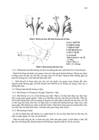 112
Hình 5. Hình ảnh thay đổi bình thường đài bể thận
Hình 6. Bàng quang niệu đạo nam
3.3.5. Những hình ảnh bất thường căn bản của đường dẫn niệu: gồm hình lồi và hình khuyết
Hình lồi là bóng mờ thuốc cản quang ở nhu mô, nằm ngoài đường Hodson. Đường này được
kẻ bằng cách nối đáy các tiểu đài, nó song song với bờ thận. Nguyên nhân thường gặp của
hình lồi là hang lao và túi thừa đài thận bẩm sinh.
∗ Hình khuyết là bóng sáng trên nền mờ của thuốc cản quang trong đường dẫn niệu.
Nguyên nhân thường gặp của hình khuyết trên NĐTM là sỏi không cản quang, máu cục, u
đường dẫn niệu.
3.4. Những hình ảnh bất thường ở thận
3.4.1. Bất thường về số lượng có thể gặp 3 thận hay 1 thận.
3.4.2. Bất thường về vị trí và bất thường trục thận: Thận sa là thận nằm thấp, trục thận thay
đổi và niệu quản ngoằn nghoèo. Thận sa có thể bẩm sinh hay mắc phải do bị đè đẩy. Thận lạc
chỗ là bất thường bẩm sinh do ngừng di chuyển của mầm thận trong thời kỳ bào thai; lạc chỗ
có thể cùng bên hoặc khác bên với thận lành. Có nhiều bất thường kết hợp: thận xoay, niệu
quản ngắn. Bất thường trục thận có thể đơn thuần. Thận hình móng ngựa là dị dạng bẩm sinh,
cực dưới nhu mô thận dính nhau, 2 bể thận niệu quản riêng, thận sigma …
3.4.3. Bất thường bờ thận:
Có thể là những thay đỗi không có ý nghĩa bệnh lý: tồn tại thùy thận thời kỳ bào thai, bờ
thận có ngấn ngang với mức các cột Bertin.
Thận trái hình lưng lạc đà, có hình tam giác, đỉnh nằm phía ngoài, có thể nhầm u thận. Bề
dày nhu mô không đổi, đường Hodson bình thường. Nguyên nhân do vết ấn của lách.
3+4+5 = NDTliÖt
6. NiÖu ®¹o mµng
7. NiÖu ®¹o hµnh
8. ND tÇng sinh m«n
9. ND d- ¬ng vËt
10. Hè thuyÒn
∗D©y ch»ng treo d- ¬ng vËt
C¬ vßng
7+8+9 = ND tr- í c
NDTL + 6 = ND sau
 