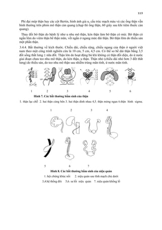 113
Phì đại mép thận hay các cột Bertin, hình ảnh giả u, cấu trúc mạch máu và các ống thận vẫn
bình thường trên phim mô thận cản quang (chụp thì ống thận, 60 giây sau khi tiêm thuốc cản
quang).
Thay đổi bờ thận do bệnh lý như u nhu mô thận, kén thận làm bờ thận có múi. Bờ thận có
ngấn lõm do viêm thận bể thận mãn, vết ngấn ở ngang mức đài thận. Bờ thận lõm do thiểu sản
một phần thận.
3.4.4. Bất thường về kích thước. Chiều dài, chiều rộng, chiều ngang của thận ở người việt
nam theo một công trình nghiên cứu là 10 cm, 5 cm, 4,5 cm. Có thể so bề dài thận bằng 3,5
đốt sống thắt lưng ± nữa đốt. Thận lớn do hoạt động bù khi không có thận đối diện, do ứ nước
giai đoạn chưa teo nhu mô thận, do kén thận, u thận. Thận nhỏ (chiều dài nhỏ hơn 3 đốt thắt
lưng) do thiểu sản, do teo nhu mô thận sau nhiễm trùng mãn tính, ứ nước mãn tính.
1 2 3 4 5 6
Hình 7. Các bất thường bẩm sinh của thận
1. thận lạc chỗ 2. hai thận cùng bên 3. hai thận dính nhau 4,5. thận móng ngựa 6.thận hình sigma.
1 2 3 4
5 6 7
Hình 8. Các bất thường bẩm sinh của niệu quản
1. hội chứng khúc nối 2. niệu quản sau tĩnh mạch chủ dưới
3,4.hệ thống đôi 5,6. sa lồi niệu quản 7. niệu quản khổng lồ
 