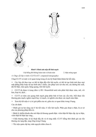 114
1
2
Hình 9. Hình ảnh niệu đồ tĩnh mạch
1.hệ thống đôi không hoàn toàn và hoàn toàn 2. thận móng ngựa
4. Chụp cắt lớp vi tính ( CLVT) (CT: computed tomography)
Chụp CLVT có một vị trí quan trọng trong số các kỹ thuật thăm khám hệ tiết niệu.
∗ Các lớp cắt theo trục cơ thể từ thận đến tiền liệt tuyến, có thể tái tạo hình ảnh theo mọi
mặt phẳng khác hoặc tái tạo hình ảnh 3 chiều, cho phép xem xét nhu mô, các đường bài xuất,
đài bể thận, niệu quản, bàng quang, tiền liệt tuyến.
∗ CLVT đo được tỉ trọng (đơn vị HU: Hounsfield unit) nên phân biệt được máu, mỡ, vôi
hóa, hoại tử, dịch...
∗ CLVT có tiêm cản quang tĩnh mạch giúp phân biệt rõ hơn các cấu trức, biết được tổn
thương giàu mạch, nghèo mạch hay vô mạch, và nghiên cứu được các mạch máu thận.
∗ Xem hệ tiết niệu ở vị trí giải phẫu của nó, giữa các cơ quan khác trong ổ bụng.
Các chỉ định:
+ Đánh giá sự lan rộng của U hệ tiết niệu, U tiền liệt tuyến. Phân giai đoạn u thận, là cơ sở
cho các phương pháp điều trị.
+ Bệnh lý nhiễm khuẩn nhu mô thận & khoang quanh thận: viêm thận bể thận cấp, áp xe thận,
viêm thận bể thận hạt vàng...
+ Chấn thương thận, là kỹ thuật đầy đủ và rõ ràng nhất. CLVT đồng thời đánh giá các tổn
thương các tạng đặc, tạng rổng trong ổ bụng.
+ Tắc niệu quản cấp hay mãn nguyên nhân chưa rõ.
 