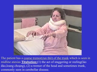 The patient has a coarse tremor(run thô) of the trunk which is seen in
midline ataxias Titubation:(1) the act of staggering or reeling(lảo
đảo,loang choạng), (2) a tremor of the head and sometimes trunk,
commonly seen in cerebellar disease.
 