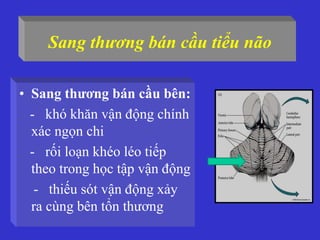 Sang thương bán cầu tiểu não
• Sang thương bán cầu bên:
- khó khăn vận động chính
xác ngọn chi
- rối loạn khéo léo tiếp
theo trong học tập vận động
- thiếu sót vận động xảy
ra cùng bên tổn thương
 