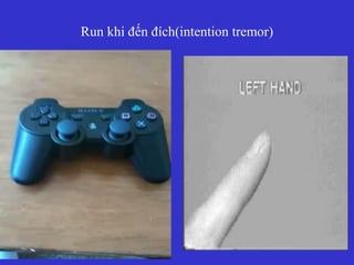Run khi đến đích(intention tremor)
 