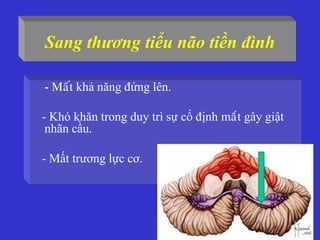 Sang thương tiểu não tiền đình
• - Maát khả năng đứng lên.
- Khó khăn trong duy trì sự cố định maét gây giật
nhãn cầu.
- Mất trương lực cơ.
 
