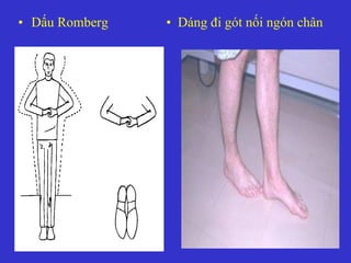 • Dấu Romberg • Dáng đi gót nối ngón chân
 