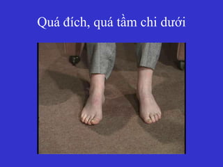 Quá đích, quá tầm chi dưới
 