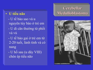 Cerebellar
Medulloblastoma• U tiểu não
- U tế bào sao và u
nguyên tủy bào ở trẻ em
- U di căn thường từ phổi
và vú
- U tế bào gai ở trẻ em từ
2-20 tuổi, lành tính và có
nang
- U hố sau (u dây VIII)
chèn ép tiểu não
 