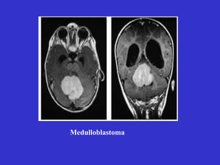Medulloblastoma
 