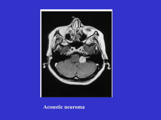 Acoustic neuroma
 