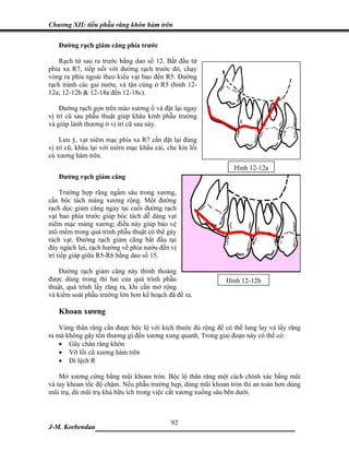 Chương XII: tiểu phẫu răng khôn hàm trên


   Đường rạch giảm căng phía trước

    Rạch từ sau ra trước bằng dao số 12. Bắt đầu từ
phía xa R7, tiếp nối với đường rạch trước đó, chạy
vòng ra phía ngoài theo kiểu vạt bao đến R5. Đường
rạch tránh các gai nướu, và tận cùng ở R5 (hình 12-
12a; 12-12b & 12-18a đến 12-18c).

    Đường rạch gọn trên mào xương ổ và đặt lại ngay
vị trí cũ sau phẫu thuật giúp khâu kính phẫu trường
và giúp lành thương ở vị trí cũ sau này.

    Lưu ý, vạt niêm mạc phía xa R7 cần đặt lại đúng
vị trí cũ, khâu lại với niêm mạc khẩu cái, che kín lồi
củ xương hàm trên.
                                                                Hình 12-12a
   Đường rạch giảm căng

     Trường hợp răng ngầm sâu trong xương,
cần bóc tách màng xương rộng. Một đường
rạch dọc giảm căng ngay tại cuối đường rạch
vạt bao phía trước giúp bóc tách dễ dàng vạt
niêm mạc màng xương; điều này giúp bảo vệ
mô mềm trong quá trình phẫu thuật có thể gây
rách vạt. Đường rạch giảm căng bắt đầu tại
đáy ngách lợi, rạch hướng về phía nướu đến vị
trí tiếp giáp giữa R5-R6 bằng dao số 15.

    Đường rạch giảm căng này thỉnh thoảng
được dùng trong thì hai của quá trình phẫu                    Hình 12-12b
thuật, quá trình lấy răng ra, khi cần mở rộng
và kiểm soát phẫu trường lớn hơn kế hoạch đã đề ra.

   Khoan xương
    Vùng thân răng cần được bộc lộ với kích thước đủ rộng để có thể lung lay và lấy răng
ra mà không gây tổn thương gì đến xương xung quanh. Trong giai đoạn này có thể có:
    • Gãy chân răng khôn
    • Vỡ lồi cũ xương hàm trên
    • Di lệch R

    Mở xương cứng bằng mũi khoan tròn. Bộc lộ thân răng một cách chính xác bằng mũi
và tay khoan tốc độ chậm. Nếu phẫu trường hẹp, dùng mũi khoan tròn thì an toàn hơn dùng
mũi trụ, dù mũi trụ khá hữu ích trong việc cắt xương xuống sâu bên dưới.



                              92
J-M. Korbendau   ___________________________________
 