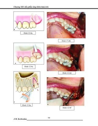 Chương XII: tiểu phẫu răng khôn hàm trên




           Hình 12-8a



                                           Hình 12-8b




            Hình 12-8c


                                           Hình 12-8d




         Hình 12-8e
                                            Hình 12-8f




                            94
J-M. Korbendau ___________________________________
 