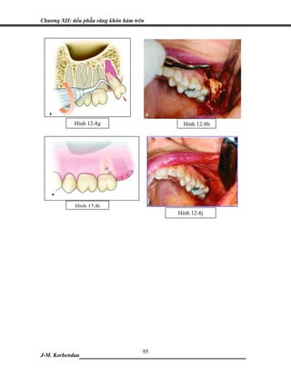 Chương XII: tiểu phẫu răng khôn hàm trên




             Hình 12-8g                      Hình 12-8h




             Hình 12-8i
                                           Hình 12-8j




                            95
J-M. Korbendau ___________________________________
 