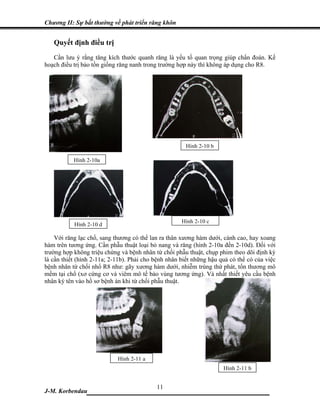 Chương II: Sự bất thường về phát triển răng khôn


   Quyết định điều trị
   Cần lưu ý rằng tăng kích thước quanh răng là yếu tố quan trọng giúp chẩn đoán. Kế
hoạch điều trị bảo tồn giống răng nanh trong trường hợp này thì không áp dụng cho R8.




                                                       Hình 2-10 b

           Hình 2-10a




                                                     Hình 2-10 c
           Hình 2-10 d

    Với răng lạc chổ, sang thương có thể lan ra thân xương hàm dưới, cành cao, hay xoang
hàm trên tương ứng. Cần phẫu thuật loại bỏ nang và răng (hình 2-10a đến 2-10d). Đối với
trường hợp không triệu chứng và bệnh nhân từ chối phẫu thuật, chụp phim theo dõi định kỳ
là cần thiết (hình 2-11a; 2-11b). Phải cho bệnh nhân biết những hậu quả có thể có của việc
bệnh nhân từ chối nhổ R8 như: gãy xương hàm dưới, nhiễm trùng thứ phát, tổn thương mô
mềm tại chổ (xơ cứng cơ và viêm mô tế bào vùng tương ứng). Và nhất thiết yêu cầu bệnh
nhân ký tên vào hồ sơ bệnh án khi từ chối phẫu thuật.




                            Hình 2-11 a
                                                                     Hình 2-11 b


                             11
J-M. Korbendau  ___________________________________
 