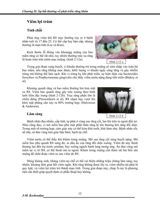 Chương II: Sự bất thường về phát triển răng khôn


   Viêm lợi trùm

   Tính chất
   Phản ứng viêm khi R8 mọc thường xảy ra ở bệnh
nhân tuổi từ 17 đến 25. Có thể cấp hay bán cấp, nhưng
thường là mạn tính (Lee và Kim).

    Kích thước lỗ thông vào khoangg miệng của bao
mầm răng có thể rất nhỏ, tuy nhiên thường múi xa răng
lộ hoàn toàn trên niêm mạc miệng. (hình 2-12a).
                                                                      Hình 2-12 a
     Trong giai đoạn xung huyết, vi khuẩn thường trú trong miệng sẽ xâm nhập vào toàn bộ
bao mầm, nếu răng không mọc được, khối lượng vi khuẩn ngày càng tăng và gây nhiễm
trùng mà không thể làm sạch. Khi vi trùng kỵ khí phát triển, sự hiện diện của bacteroides
forsythus và Porphyromonas gingivalis cho thấy viêm nướu nặng đang tiến triển (Blakey et
al).

    Khoảng quanh răng và bao mầm thường lớn hơn mặt
xa R8. Viêm bao quanh răng gây tiêu xương theo hình
lưỡi liềm đặc trưng (hình 2-12b). Trục răng phần lớn là
chiều đứng (Punwutikorn et al). R8 chạm hay vượt lên
khỏi mặt phẳng cắn xảy ra 80% trường hợp. (Halverson
& Anderson).

   Lâm sàng                                                           Hình 2-12 b
    Bệnh nhân đau nhiều, cấp tính, tự phát ở vùng sau răng cối, lan lên trên ra ngoài đến tai.
Nhai cũng đau, vì mô mềm bao phủ một phần thân răng bị tổn thương bởi răng đối diện.
Trong một số trường hợp, cảm giác này có thể kèm khó nuốt, khít hàm nhẹ. Bệnh nhân sốt,
nề nhẹ, sờ đau vùng tam giác hậu hàm, hạch tại chỗ.

   Viêm nướu có thể thấy khi khám trong miệng. Mô sau răng cối sung huyết nặng. Mô
mềm bao phủ quanh R8 sưng đỏ, in dấu ấn của răng đối diện xuống. Viêm đỏ này thỉnh
thoảng lan đến trụ trước amidan, hay xuống ngách hành lang tương ứng. Ấn đau vùng mô
mềm tại vị trí R8, có thể thoát mủ ra ngoài. Khám trong miệng cần thám sát hai bên sàn
miệng để chẩn đoán viêm sơ sau viêm do R8.

    Dùng kháng sinh, kháng viêm tại chỗ có thể cải thiện những triệu chứng lâm sàng; tuy
nhiên, khoảng thời gian hết viêm ngắn. Khi răng không được lấy ra, viêm nhiễm tái phát là
quy luật, và viêm lợi trùm trở thành mạn tính. Trong giai đoạn này, chụp X-ray là phương
tiện cần thiết giúp quyết định có phẫu thuật hay không.




                              12
J-M. Korbendau   ___________________________________
 