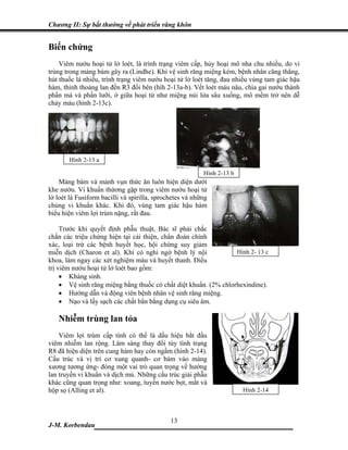 Chương II: Sự bất thường về phát triển răng khôn


Biến chứng
    Viêm nướu hoại tử lở loét, là trình trạng viêm cấp, hủy hoại mô nha chu nhiều, do vi
trùng trong mảng bám gây ra (Lindhe). Khi vệ sinh răng miệng kém, bệnh nhân căng thẳng,
hút thuốc lá nhiều, trình trạng viêm nướu hoại tử lở loét tăng, đau nhiều vùng tam giác hậu
hàm, thỉnh thoảng lan đến R3 đối bên (hìh 2-13a-b). Vết loét màu nâu, chia gai nướu thành
phần má và phần lưỡi, ở giữa hoại tử như miệng núi lửa sâu xuống, mô mềm trở nên dễ
chảy máu (hình 2-13c).




       Hình 2-13 a

                                                          Hình 2-13 b
    Mảng bám và mảnh vụn thức ăn luôn hiện diện dưới
khe nướu. Vi khuẩn thừơng gặp trong viêm nướu hoại tử
lở loét là Fusiform bacilli và spirilla, sprochetes và những
chủng vi khuẩn khác. Khi đó, vùng tam giác hậu hàm
biểu hiện viêm lợi trùm nặng, rất đau.

     Trước khi quyết định phẫu thuật, Bác sĩ phải chắc
chắn các triệu chứng hiện tại cải thiện, chẩn đoán chính
xác, loại trừ các bệnh huyết học, hội chứng suy giảm
miễn dịch (Charon et al). Khi có nghi ngờ bệnh lý nội             Hình 2- 13 c
khoa, làm ngay các xét nghiệm máu và huyết thanh. Điều
trị viêm nướu hoại tử lở loét bao gồm:
     • Kháng sinh.
     • Vệ sinh răng miệng bằng thuốc có chất diệt khuẩn. (2% chlorhexindine).
     • Hướng dẫn và động viên bệnh nhân vệ sinh răng miệng.
     • Nạo và lấy sạch các chất bẩn bằng dụng cụ siêu âm.

   Nhiễm trùng lan tỏa
    Viêm lợi trùm cấp tính có thể là dấu hiệu bắt đầu
viêm nhiễm lan rộng. Lâm sàng thay đổi tùy tình trạng
R8 đã hiện diện trên cung hàm hay còn ngầm (hình 2-14).
Cấu trúc và vị trí cơ xung quanh- cơ bám vào màng
xương tương ứng- đóng một vai trò quan trọng về hướng
lan truyền vi khuẩn và dịch mủ. Những cấu trúc giải phẫu
khác cũng quan trọng như: xoang, tuyến nước bọt, mắt và
hộp sọ (Alling et al).                                                  Hình 2-14



                              13
J-M. Korbendau   ___________________________________
 