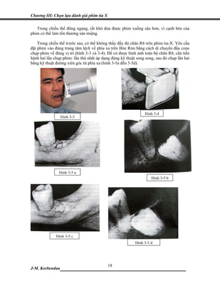 Chương III: Chọn lựa đánh giá phim tia X

   Trong chiều thế đứng ngang, rất khó đưa được phim xuống sâu hơn, vì cạnh bén của
phim có thể làm tổn thương sàn miệng.

    Trong chiều thế tr ư ớc sau, có thể không thấy đầy đủ chân R8 trên phim tia-X. Yêu cầu
đặt phim vào đúng trung tâm lệch về phía xa trên Bite Rim bằng cách di chuyển đầu cone
chụp phim về đúng vị trí (hình 3-3 và 3-4). Để có được hình ảnh toàn bộ chân R8, cần tiến
hành hai lần chụp phim: lần thứ nhất áp dụng đúng kỹ thuật song song, sau đó chụp lần hai
bằng kỹ thuật đường xiên góc từ phía xa (hình 3-5a đến 3-5d).




                                                                Hình 3-4
                 Hình 3-3




                Hình 3-5 a
                                                                    Hình 3-5 b




              Hình 3-5 c
                                                           Hình 3-5 d




                             18
J-M. Korbendau  ___________________________________
 