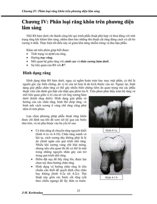 Chương IV: Phân loại răng khôn trên phương diện lâm sàng


Chương IV: Phân loại răng khôn trên phương diện
lâm sàng
    Nhổ R8 hàm dưới chỉ thành công khi qui trình phẫu thuật phù hợp và thoả đáng với tình
trạng răng khi khám lâm sàng, nhằm đảm bảo những thủ thuật cắt răng đúng cách và cắt bỏ
xương ít nhất. Thực hiện tốt điều này sẽ giảm khả năng nhiễm trùng và đau hậu phẫu.

   Khảo sát trên phim giúp biết được:
   • Tình trạng và vị trí của răng.
   • Hướng trục răng.
   • Mối quan hệ giữa răng với cành cao và thân xương hàm dưới.
   • Sự liên quan của R8 với R7.

Hình dạng răng
   Hình dạng thân R8 hàm dưới, ngay cả ngầm hoàn toàn hay mọc một phần, có thể là
nguồn gốc các biến chứng, do vị trí của nó hơn là do kích thước của nó. Ngược lại, hình
dạng giải phẫu chân răng có thể gây nhiều biến chứng tiềm ẩn quan trọng mà các phẫu
thuật viên cần đánh giá thật cẩn thận qua phim tia-X. Trên phim phải thấy toàn bộ răng và
mối liên quan giữa vị trí của nó với ống xương hàm
dưới (kênh răng dưới). Hình dạng giải phẫu và
hướng của các chân răng, hình thể chóp răng, và
hình ảnh vách xương ổ vùng chẽ răng cũng phải
nhìn rõ trên phim.

   Lựa chọn phương pháp phẫu thuật răng khôn
được chỉ định sau khi đã xem xét kỹ qua các bước
như trên, và nó phụ thuộc vào ba yếu tố sau:

       •   Có khả năng di chuyển răng nguyên khối                Hình 4-1a
           (hình 4-1a và 4-1b). Chân răng mảnh và
           hội tụ, vách xương dày không phải là lý
           do chính ngăn cản quá trình nhổ răng.
           Nhiều khi xương vùng chẽ khá mỏng,
           nhưng nếu chủ quan thì đó có thể là một
           trong những nguyên nhân gây cản trở
           trong quá trình nhổ răng.
       •   Điểm đặt nạy để bẩy răng lên, được lựa
           chọn tuỳ theo hướng chân răng.
       •   Hình dạng và hướng chân răng là tiêu
           chuẩn cần thiết để quyết định chia chân
           hay không (hình 4-2a tới 4-2c). Thủ
           thuật này gồm các bước cắt răng (cắt                  Hình 4-1 b
           theo chiều ngang) để lấy thân ra trước.


                             23
J-M. Korbendau  ___________________________________
 