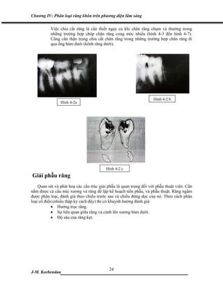 Chương IV: Phân loại răng khôn trên phương diện lâm sàng

          Việc chia cắt răng là cần thiết ngay cả khi chân răng chụm và thường trong
          những trường hợp chóp chân răng cong móc nhiều (hình 4-3 đến hình 4-7).
          Cũng cần thận trọng chia cắt chân răng trong những trường hợp chân răng đi
          qua ống hàm dưới (kênh răng dưới).




                                                                    Hình 4-2 b
                Hình 4-2a




                                         Hình 4-2 c
Giải phẫu răng
    Quan sát và phát hoạ các cấu trúc giải phẫu là quan trọng đối với phẫu thuật viên. Cần
nắm được cả cấu trúc xương và răng để lập kế hoạch tiền phẫu, và phẫu thuật. Răng ngầm
được phân loại, đánh giá theo chiều trước sau và chiều đứng dọc của nó. Theo cách phân
loại cổ điển (nhiều thập kỷ cách đây) thì có khuynh hướng đánh giá:
            • Hướng trục răng.
            • Sự liên quan giữa răng và cành lên xương hàm dưới.
            • Độ sâu của răng kẹt.




                             24
J-M. Korbendau  ___________________________________
 