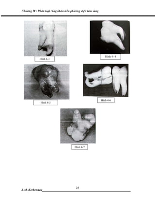 Chương IV: Phân loại răng khôn trên phương diện lâm sàng




                                                              Hình 4- 4
             Hình 4-3




                                                           Hình 4-6
             Hình 4-5




                                      Hình 4-7




                            25
J-M. Korbendau ___________________________________
 