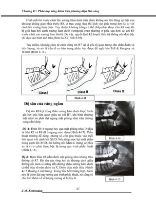 Chương IV: Phân loại răng khôn trên phương diện lâm sàng

    Hình ảnh bờ trước cành lên xương hàm dưới trên phim không nói lên đúng sự thật của
khoảng không gian phía trước R8, vì trục cung răng thì lệch vào phía trong hơn là so với
cành lên xương hàm dưới. Tuy nhiên, khoảng trống có thể chấp nhận được cho R8 mọc thì
bị giới hạn bởi cạnh xương hàm dưới (temporal crest-thường ở phía sau hơn so với bờ
trước cành cao xương hàm dưới). Do vậy, quyết định kế hoạch điều trị không nên đơn độc
chỉ dựa vào hình ảnh trên phim tia X (Hình 4-10).

    Tuy nhiên, khoảng cách từ cành đứng tới R7 lại là yếu tố quan trọng cho chẩn đoán và
tiên lượng, và nó là yếu tố cơ bản trong phân loại được đề nghị bởi Pell & Gregory và
Winter (Hình 4-11).




                                           Hình 4-11

  Độ sâu của răng ngầm
   Độ sâu R8 kẹt trong thân xương hàm dưới được đánh
giá bởi mối liên quan giữa nó với R7, khi bình thường
mặt nhai nó phải đạt ngang mặt phẳng nhai trên đường
cong cắn khớp.

 Độ A: Đỉnh R8 ở ngang hay qua mặt phẳng nhai. Nghĩa
là thân R7 và R8 đã ở ngang mức nhau (Hình 4-17). Phẫu
thuật thường dễ dàng, nhưng nó còn phụ thuộc vào mối
liên quan với cành lên XHD. Nếu răng mọc kẹt một phần               Hình 4-16
trong cành lên XHD, thì đường nối Men-xi măng về phía
xa là vị trí phải được bộc lộ trong quá trình phẫu thuật
(Hình 4-18).

Độ B: Đỉnh thân R8 nằm dưới mặt phẳng nhai nhưng trên
đường cổ R7. Độ sâu của răng kẹt và khoảng cách giữa
đường nối men-xi măng đến đường chéo xương hàm dưới
có thể thấy rõ trên phim tia X. Điểm thấp nhất thấy ở hình
4-16 thường ở mặt trong. Trong hầu hết trường hợp, điểm
này là điểm đặt nạy trong quá trình phẫu thuật, nó cũng sẽ
cho biết thêm về số lượng xương sẽ bị lấy đi.                       Hình 4-17


                              27
J-M. Korbendau   ___________________________________
 