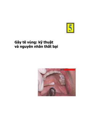 Gây tê vùng: kỹ thuật
và nguyên nhân thất bại
 