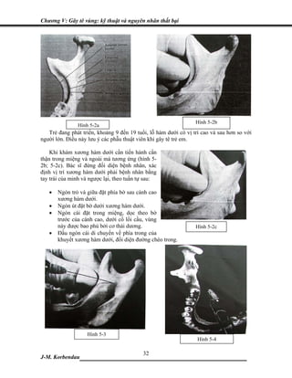 Chương V: Gây tê vùng: kỹ thuật và nguyên nhân thất bại




                                                                 Hình 5-2b
               Hình 5-2a
   Trẻ đang phát triển, khoảng 9 đến 19 tuổi, lỗ hàm dưới có vị trí cao và sau hơn so với
người lớn. Điều này lưu ý các phẫu thuật viên khi gây tê trẻ em.

    Khi khám xương hàm dưới cần tiến hành cẩn
thận trong miệng và ngoài má tương ứng (hình 5-
2b; 5-2c). Bác sĩ đứng đối diện bệnh nhân, xác
định vị trí xương hàm dưới phải bệnh nhân bằng
tay trái của minh và ngược lại, theo tuần tự sau:

   •   Ngón trỏ và giữa đặt phía bờ sau cành cao
       xương hàm dưới.
   •   Ngón út đặt bờ dưới xương hàm dưới.
   •   Ngón cái đặt trong miệng, dọc theo bờ
       trước của cành cao, dưới cổ lồi cầu, vùng
       này được bao phủ bởi cơ thái dương.                       Hình 5-2c
   •   Đầu ngón cái di chuyển về phía trong của
       khuyết xương hàm dưới, đối diện đường chéo trong.




                   Hình 5-3
                                                                  Hình 5-4

                             32
J-M. Korbendau  ___________________________________
 
