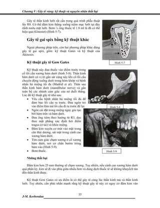 Chương V: Gây tê vùng: kỹ thuật và nguyên nhân thất bại

    Gây tê thần kinh lưỡi rất cần trong quá trình phẫu thuật
lấy R8. Có thể đâm kim thẳng xuống niêm mạc lưỡi tại đáy
rãnh nướu mặt lưỡi. Bơm ¼ ống thuốc tê 1.8 ml là đã có thể
hiệu quả (Ginestet) (Hình 5-7).

   Gây tê gai spix bằng kỹ thuật khác
   Ngoài phương pháp trên, còn hai phương pháp khác dùng
gây tê gai spix, gồm: kỹ thuật Gates và kỹ thuật của
Akinosis.

   Kỹ thuật gây tê Gow Gates                                           Hình 5-7

    Kỹ thuật này đưa thuốc vào điểm trước trong
cổ lồi cầu xương hàm dưới (hình 5-8). Thần kinh
hàm dưới có vị trí gần sát vùng này khi cổ lồi cầu
chuyển động xuống dưới trong hỏm khớp và bệnh
nhân há miệng tối đa (Madrid et al). Thân sau
thần kinh hàm dưới (mandibular nerve) và gần
toàn bộ các nhánh cảm giác của nó duỗi thẳng.
Lúc đó kỹ thuật gây tê như sau:
    • Yêu cầu bệnh nhân há miệng tối đa để
        đảm bảo lồi cầu ra trước. Đưa ngón trỏ
        vào điểm lõm mà lồi cầu đi ra trước để lại.                Hình 5-8
    • Ngón cái đặt trong miệng ngay góc tạo
        bởi hàm trên và hàm dưới.
    • Đưa ống tiêm theo hướng từ R3, dọc
        theo mặt phẳng xác định bởi điểm
        tragus (ở tai) và khóe miệng.
    • Đâm kim xuyên cơ mút vào mặt trong
        cân thái dương, sát mặt trong cành cao
        xương hàm dưới.
    • Tìm cảm giác chạm xương ở cổ xương
        hàm dưới, nơi cơ chân bướm trong
        bám vào (Hình 5-9).
    • Bơm thuốc.                                                Hình 5-9

   Những thất bại

   Đâm kim hơn 25 mm thường sẽ chạm xương. Tuy nhiên, nếu cành cao xương hàm dưới
quá phân kỳ, kim sẽ đi vào phía giữa nhiều hơn và dung dịch thuốc tê sẽ không khuyếch tán
đến thần kinh được.

    Kỹ thuật Gow Gates có ưu điểm là có thể gây tê cùng lúc thần kinh má và thần kinh
lưỡi. Tuy nhiên, cần phải nhấn mạnh rằng kỹ thuật gây tê này có nguy cơ đâm kim vào


                              35
J-M. Korbendau   ___________________________________
 