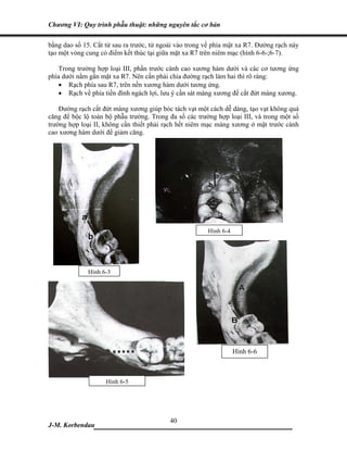 Chương VI: Quy trình phẫu thuật: những nguyên tắc cơ bản

bằng dao số 15. Cắt từ sau ra trước, từ ngoài vào trong về phía mặt xa R7. Đường rạch này
tạo một vòng cung có điểm kết thúc tại giữa mặt xa R7 trên niêm mạc (hình 6-6-;6-7).

   Trong trường hợp loại III, phần trước cành cao xương hàm dưới và các cơ tương ứng
phía dưới nằm gần mặt xa R7. Nên cần phải chia đường rạch làm hai thì rõ ràng:
   • Rạch phía sau R7, trên nền xương hàm dưới tương ứng.
   • Rạch về phía tiền đình ngách lợi, lưu ý cần sát màng xương để cắt đứt màng xương.

    Đường rạch cắt đứt màng xương giúp bóc tách vạt một cách dễ dàng, tạo vạt không quá
căng để bộc lộ toàn bộ phẫu trường. Trong đa số các trường hợp loại III, và trong một số
trường hợp loại II, không cần thiết phải rạch hết niêm mạc màng xương ở mặt trước cành
cao xương hàm dưới để giảm căng.




                                                        Hình 6-4




              Hình 6-3




                                                                   Hình 6-6



                    Hình 6-5




                             40
J-M. Korbendau  ___________________________________
 
