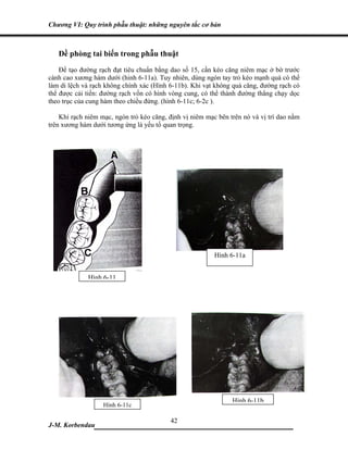 Chương VI: Quy trình phẫu thuật: những nguyên tắc cơ bản



   Đề phòng tai biến trong phẫu thuật
    Để tạo đường rạch đạt tiêu chuẩn bằng dao số 15, cần kéo căng niêm mạc ở bờ trước
cành cao xương hàm dưới (hinh 6-11a). Tuy nhiên, dùng ngón tay trỏ kéo mạnh quá có thể
làm di lệch và rạch không chính xác (Hình 6-11b). Khi vạt không quá căng, đường rạch có
thể được cải tiến: đường rạch vốn có hình vòng cung, có thể thành đường thẳng chạy dọc
theo trục của cung hàm theo chiều đứng. (hình 6-11c; 6-2c ).

    Khi rạch niêm mạc, ngón trỏ kéo căng, định vị niêm mạc bên trên nó và vị trí dao nằm
trên xương hàm dưới tương ứng là yếu tố quan trọng.




                                                          Hình 6-11a


             Hình 6-11




                                                                Hình 6-11b
                   Hình 6-11c

                             42
J-M. Korbendau  ___________________________________
 