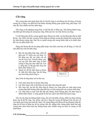 Chương VI: Quy trình phẫu thuật: những nguyên tắc cơ bản




   Cắt răng
   Khi xương phía trên ngoài được lấy đi, thử lấy răng ra mà không cần cắt răng; số lượng
xương lấy ra được xác định bởi kích thước khoảng không gian quanh răng, phụ thuộc vào
mức độ viêm nhiễm của bao mầm răng.

   Nếu răng có độ nghiêng trung bình, có thể thử lấy ra bằng nạy. Nếu không thành công,
cần đánh giá khả năng cắt xương hay răng. Điều này tùy vào mức độ kẹt của răng.

    Có thể dùng đục để lấy xương quanh răng. Khoan tạo rãnh, sau đó dùng đục đặt tại rãnh
đã tạo. Tuy nhiên, khi đục xương có khả năng tạo đường xương gãy không như mong muốn
do rãnh khoan xương hẹp. Đục lấy ra mảnh xương như mong muốn thật sự là thách thức
đối với các phẫu thuật viên.

   Dùng mũi khoan để cắt cho phép phẫu thuật viên kiểm soát thao tác dễ dàng. Có thể cắt
một phần hay toàn bộ thân răng:

   •   Khi cắt một phần thân răng, rãnh cắt
       phải quá 2/3 chiều sâu của răng. Có
       thể dùng nạy đặt vào rãnh vừa cắt
       sau đó xoay nạy. Chuyển động xoay
       của nạy làm tách thân răng ra khỏi
       xương ổ răng dọc theo rãnh cắt. Lưu
       ý, dùng đục có thể gây khó chịu cho
       bệnh nhân (hình 6-21).
   •   Ngược lại, để lấy thân răng ra, khoan
       lổ, rãnh trên thân răng. Sau đó dùng
       nạy tách từng mảnh răng ra.                          Hình 6-21

   Quy trình cắt răng được mô tả như sau:

   •   Chia chân răng nếu ta cắt dọc thân răng.
   •   Lấy thân răng ra để có thể thám sát trực tiếp chân răng bên dưới.
   •   Mở vùng chẽ, sau khi lấy thân răng đi, khoan vào vùng giữa các chân răng trong
       trường hợp định hướng chân răng khó hay có hiện tượng quá sản cement chân răng.
   •   Lấy chân răng ra một cách độc lập nhẹ nhàng, thỉnh thoảng phải cắt chân răng ra
       thành nhiều mảnh, vì xung quanh là cấu trúc mạch máu thần kinh quan trọng.

    Nếu chỉ cắt răng mà không thành công, cần mở một phần xương, nhằm tạo được đường
thoát vừa đủ để lấy răng. Tuy nhiên, cần lưu ý rằng mô xương thì không bị đè nén hay vỡ
vụn nhiều quá trong quá trình lấy răng. Cắt xương bằng mũi khoan để tạo khoảng trống lấy
răng thì tốt hơn là dùng lực đè ép xương. Khi đó, những biến chứng phẫu thuật như gãy
xương hàm dưới hoàn toàn hay không hoàn toàn, nhiễm trùng do hoại tử xương có thể
tránh được.

                             47
J-M. Korbendau  ___________________________________
 